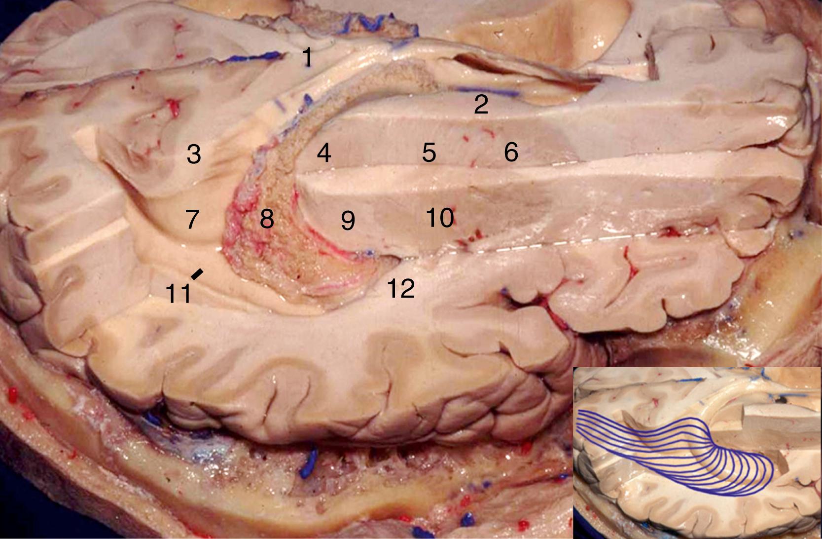 Figure 2.11, Superolateral view of the right hemisphere. 1, Splenium of corpus callosum; 2, head of caudate nucleus; 3, bulb of callosum; 4, thalamus; 5, genu of internal capsule; 6, anterior limb of internal capsule; 7, calcar avis; 8, choroid plexus; 9, retrolentiform part of internal capsule; 10, lentiform nucleus; 11, tail of hippocampus; 12, sublentiform part of internal capsule. Inset, Fibers of optic radiation.