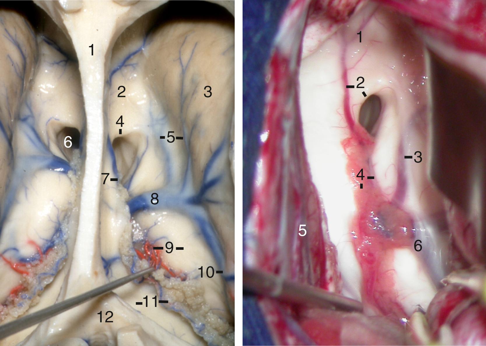 Figure 2.10, Left, Superior view of the frontal horn, body, and atrium of the lateral ventricles; the choroidal fissure on the right ventricle has been split through taenia fornicis. 1, Body of corpus callosum; 2, rostrum of corpus callosum; 3, head of caudate nucleus; 4, column of fornix; 5, anterior caudate veins; 6, left foramen of Monro; 7, anterior septal vein; 8, thalamostriate vein; 9, thalamus and medial posterior choroidal artery branches (under the superior membrane of tela choroidea); 10, thalamostriate vein; 11, crus of fornix and choroid plexus; 12, splenium of corpus callosum. Right, Surgical photograph of the superior view of the right lateral ventricle. 1, Rostrum of corpus callosum; 2, anterior septal vein and column of fornix; 3, anterior caudate vein; 4, choroid plexus and taenia fornicis; 5, falx; 6, thalamostriate vein. Note that in this case the thalamostriate vein drains far posteriorly to the foramen of Monro; if necessary, the foramen of Monro can be “enlarged” posteriorly by splitting the choroidal fissure to access the third ventricle.