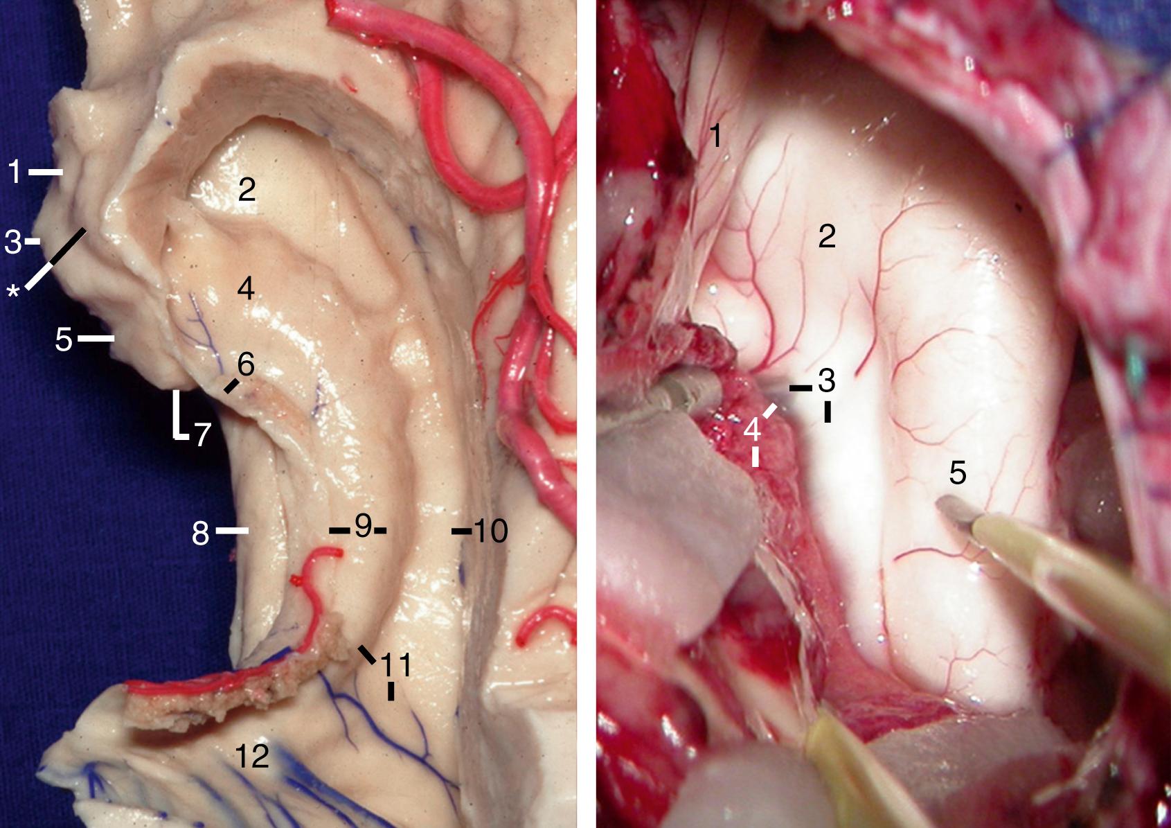 Figure 2.9, Left, Superior view of floor of right temporal horn. 1, Uncus (anterior segment); 2, uncal recess (between the amygdala and head of hippocampus); 3, uncus (apex); 4, head of hippocampus; 5, uncus (posterior segment); 6, inferior choroidal point; 7, intralimbic gyrus; 8, parahippocampal gyrus; 9, fimbria of fornix and body of hippocampus; 10, collateral eminence; 11, tail of hippocampus and collateral trigone; 12, medial wall of atrium. ∗, semilunar gyrus. Right, Surgical view of the floor of the right temporal horn. 1, Amygdala; 2, head of hippocampus; 3, taenia fimbriae and fimbria of fornix; 4, choroid plexus and inferior choroidal point; 5, body of hippocampus.