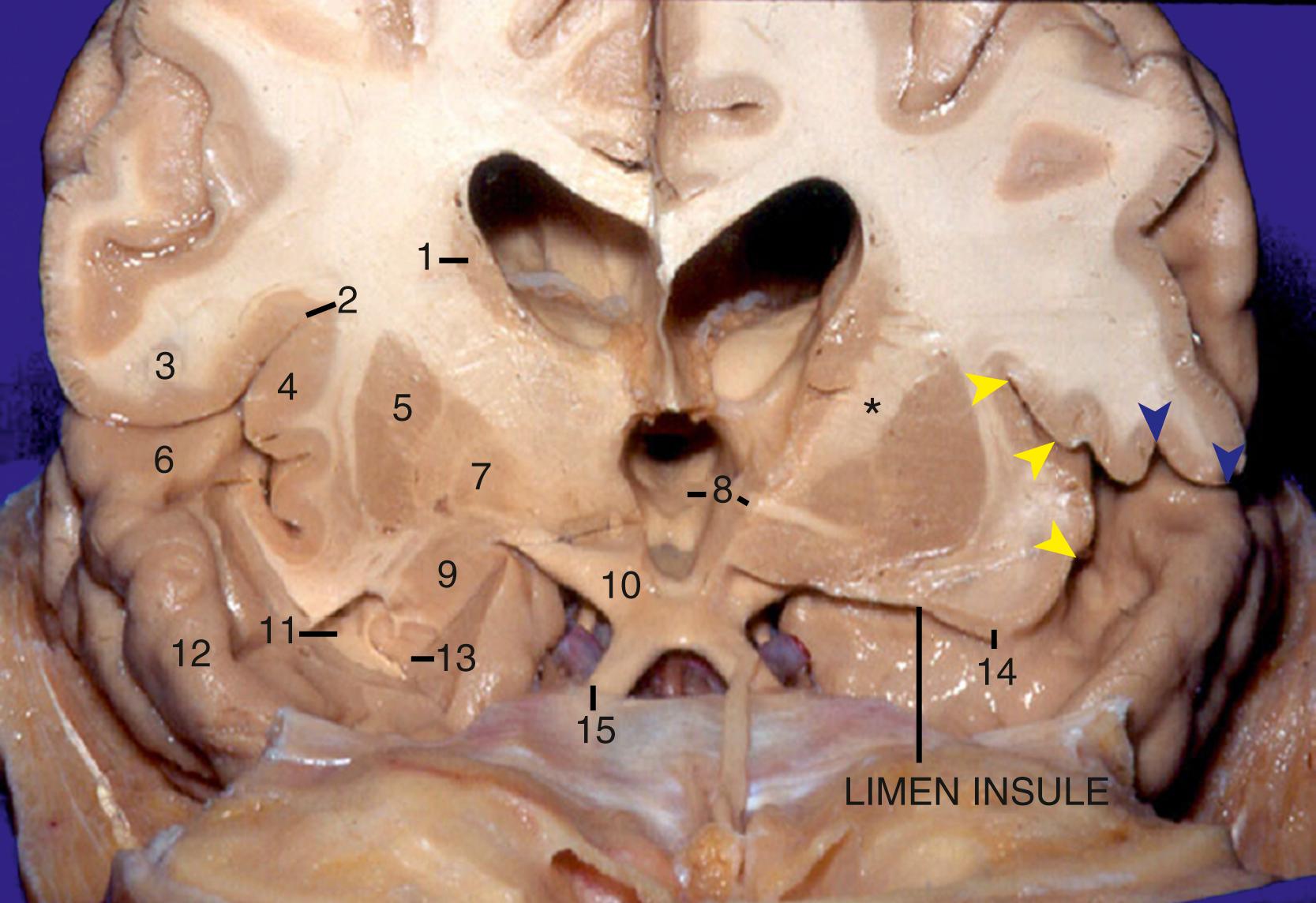 eFigure 2.5, Coronal view. 1, Body of caudate nucleus; 2, superior limiting sulcus of insula; 3, postcentral gyrus; 4, insular cortex; 5, putamen; 6, Heschl gyrus; 7, globus pallidus; 8, floor of third ventricle and anterior commissure; 9, amygdala; 10, optic tract; 11, collateral eminence and temporal horn; 12, vertical portion of planum polare; 13, head of hippocampus; 14, insular pole; 15, optic nerve; ∗, transition between anterior limb and genu of internal capsule at foramen of Monro. Blue arrowheads indicate lateral opercular compartment; yellow arrowheads indicate lateral insular compartment of the sylvian fissure. Note that the position of the caudate nucleus is higher than the superior limiting sulcus of the insula; also note that the amygdala blends into the globus pallidus, and the optic tract can serve as surgical landmark for determining the superior limit of amygdalar resection.