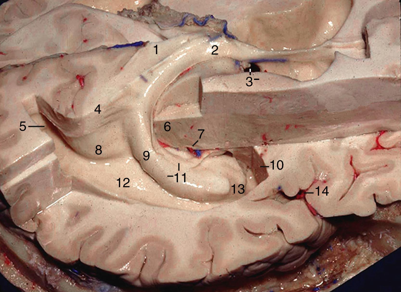 eFigure 2.7, Superolateral view of the right hemisphere. 1, Splenium of the corpus callosum; 2, body of fornix; 3, foramen of Monro and head of the caudate nucleus; 4, bulb of callosum; 5, occipital horn; 6, thalamus; 7, lateral geniculate body ( red and blue structures indicate the inferior choroidal point); 8, calcar avis; 9, tail of hippocampus; 10, amygdala; 11, fimbria of fornix and body of hippocampus; 12, collateral trigone; 13, head of hippocampus; 14, anterior limiting sulcus of insula.