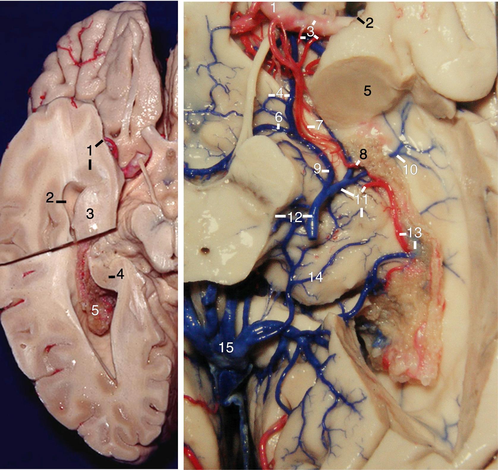 eFigure 2.9, Left, Basal view. 1, Amygdala and rhinal incisura; 2, roof of temporal horn; 3, head of hippocampus; 4, tail of hippocampus; 5, choroid plexus. Right, Basal view of the roof of the temporal horn. 1, Supraclinoid carotid artery; 2, rhinal incisura; 3, M1 segment of middle cerebral artery and lateral lenticulostriate arteries; 4, optic tract and striate segment of basal vein; 5, amygdala; 6, peduncular vein; 7, anterior choroidal artery (cisternal segment); 8, inferior choroidal point; 9, peduncular segment of basal vein; 10, inferior ventricular vein; 11, inferior ventricular vein, anterior choroidal artery, and lateral geniculate body; 12, posterior mesencephalic segment of basal vein and lateral mesencephalic sulcus; 13, choroid plexus and anterior choroidal artery (plexal segment); 14, pulvinar of thalamus; 15, vein of Galen.