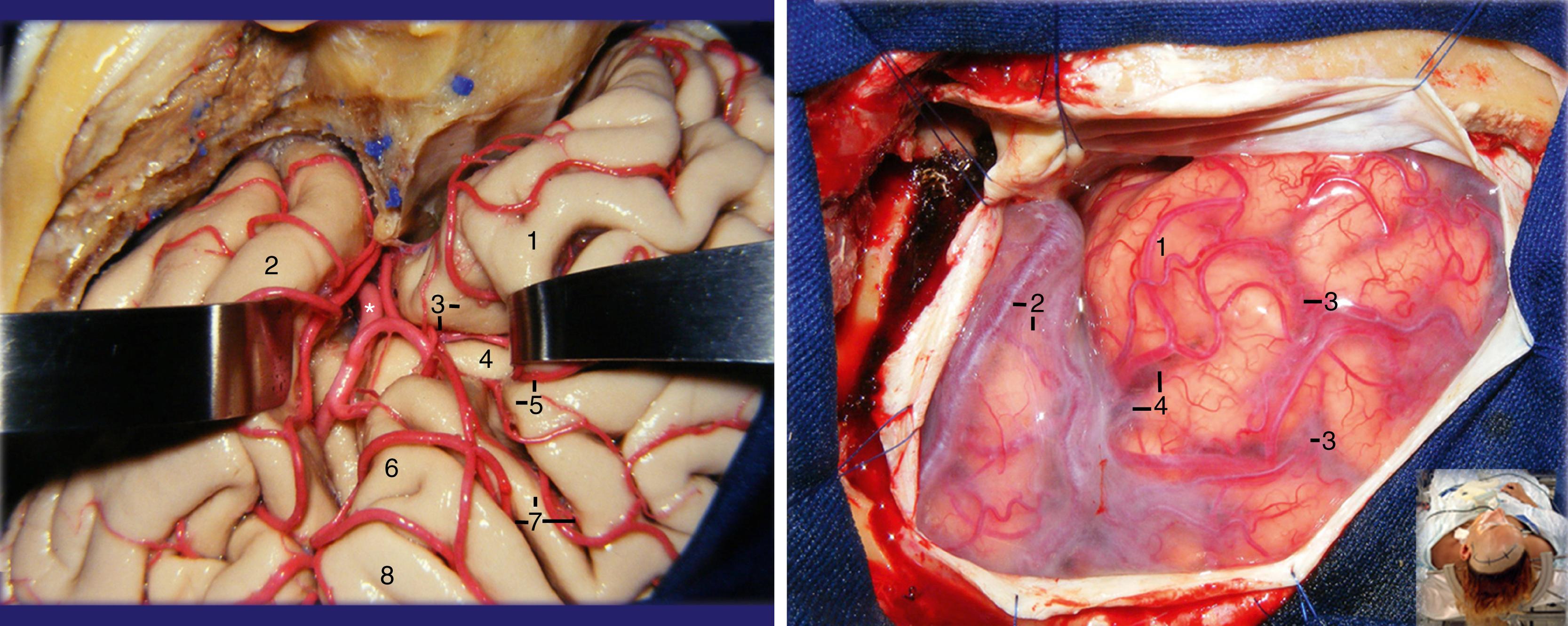 Figure 2.2, Left, Anatomic dissection mimicking a left pretemporal transsylvian approach. The pars orbitalis has been retracted frontally to expose the anterior limiting sulcus of the insula. 1, Pars orbitalis; 2, superior temporal gyrus; 3, lateral orbital gyrus and anterior limiting sulcus of insula; 4, first short gyrus of insula; 5, tip of the pars triangularis and the anterior horizontal ramus of the sylvian fissure; 6, precentral gyrus; 7, pars opercularis, anterior horizontal ramus of the sylvian fissure, and the precentral sulcus; 8, postcentral gyrus. Right, Surgical photograph of a left pterional approach. 1, Pars orbitalis; 2, superior temporal gyrus and superficial sylvian vein; 3, inferior frontal sulcus; 4, tip of the pars triangularis and the anterior horizontal ramus. The inset displays the positioning of the patient.