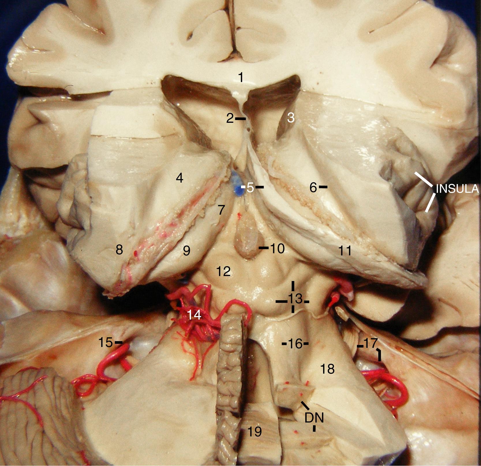 Figure 2.12, Posterior view. 1, Corpus callosum; 2, septum pellucidum; 3, caudate nucleus; 4, thalamus (floor of the body of lateral ventricle); 5, internal cerebral vein and body of fornix; 6, striothalamic sulcus; 7, thalamus (upper lateral wall of third ventricle); 8, pulvinar of thalamus (anterior wall of atrium); 9, pulvinar of thalamus (superolateral wall of quadrigeminal cistern); 10, pineal gland; 11, crus of fornix; 12, superior colliculus; 13, brachium of inferior colliculus, inferior colliculus, lateral mesencephalic sulcus, and trochlear nerve; 14, cerebellomesencephalic segment of superior cerebellar artery; 15, internal acoustic meatus; 16, superior cerebellar peduncle and interpeduncular sulcus; 17, trigeminal nerve and internal acoustic meatus; 18, middle cerebellar peduncle; 19, nodule; DN, dentate nucleus. The red dots at the posterior part of the superior cerebellar peduncle and on the dentate nucleus are perforators from the superior cerebellar artery supplying deep cerebellar nuclei.