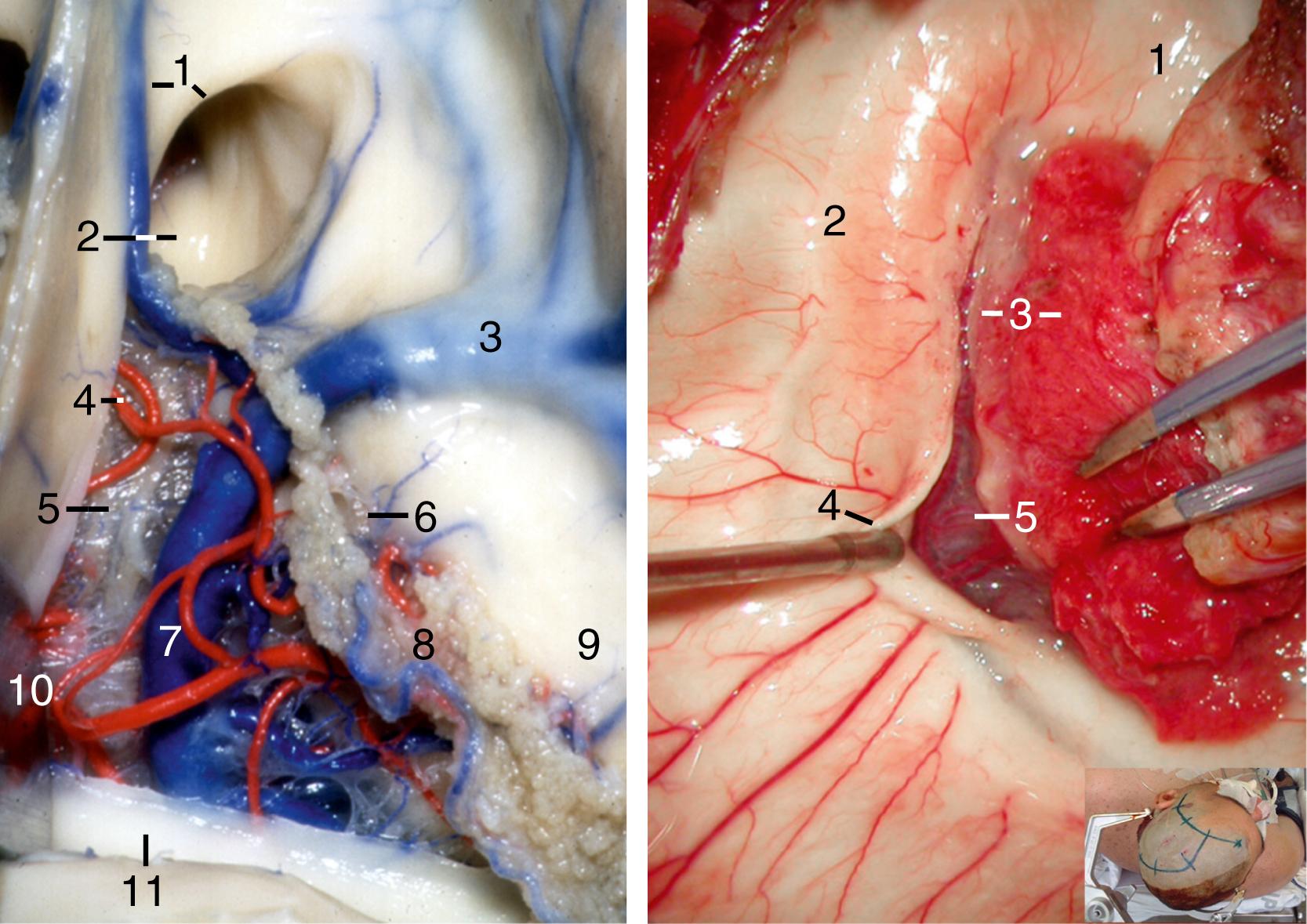 Figure 2.13, Left, The body of fornix has been retracted medially by splitting the choroidal fissure through the taenia fornicis, and the superior membrane of tela choroidea has been removed to display the contents of velum interpositum. 1, Anterior septal vein and column of fornix; 2, foramen of Monro; 3, thalamostriate vein; 4, branch of medial posterior choroidal artery; 5, inferior membrane of tela choroidea; 6, taenia choroidea; 7, internal cerebral vein; 8, choroid plexus; 9, thalamus; 10, retractor; 11, body of fornix. Right, Surgical photograph; superior view of the left temporal horn and atrium. 1, Head of hippocampus; 2, body of hippocampus; 3, choroid plexus and taenia fimbriae (split); 4, fimbria of fornix; 5, arachnoid membrane of hippocampal sulcus, hippocampal artery branches, and transverse hippocampal veins. This route communicates the atrium to the ambient cistern. The inset displays the position of the head.