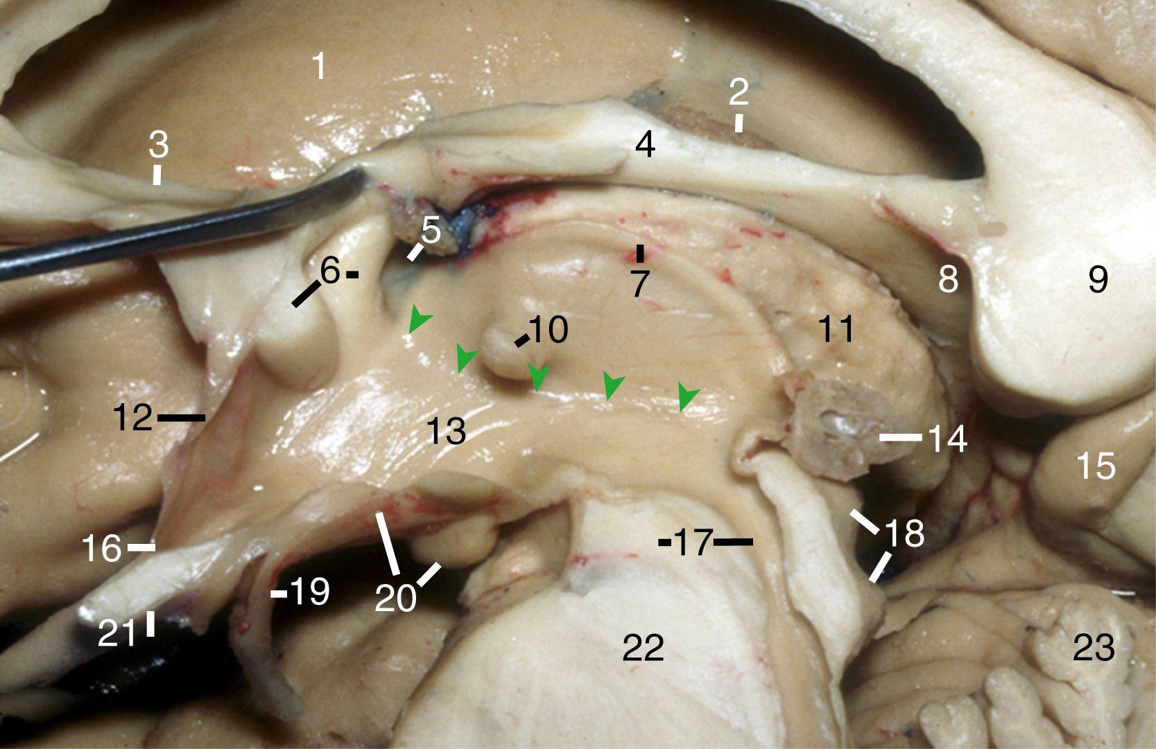 Figure 2.14, Midsagittal cut displaying the third ventricle. 1, Right caudate nucleus; 2, choroid plexus of right lateral ventricle; 3, rostrum of corpus callosum; 4, body of fornix; 5, foramen of Monro; 6, anterior commissure and column of fornix; 7, striae medullary thalami; 8, crus of fornix; 9, splenium of corpus callosum; 10, massa intermedia; 11, thalamus; 12, lamina terminalis; 13, hypothalamus; 14, pineal gland; 15, isthmus of cingulate gyrus; 16, optic recess; 17, midbrain and aqueduct; 18, superior and inferior colliculi; 19, pituitary stalk; 20, tuber cinereum and mammillary body; 21, optic chiasm; 22, pons; 23, culmen of cerebellum. Green dots indicate hypothalamic sulcus.