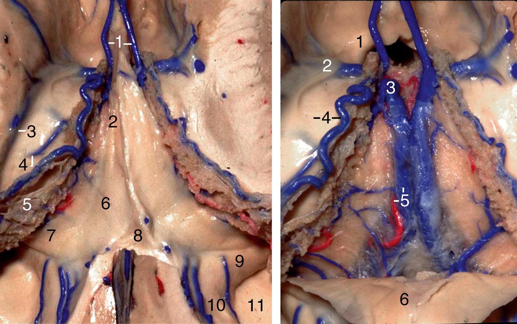 Figure 2.15, Left, Superior view of both lateral ventricles. 1, Anterior septal veins; 2, body of fornix; 3, striothalamic sulcus and thalamostriate vein; 4, superior thalamic vein; 5, choroid plexus; 6, body of fornix; 7, crus of fornix; 8, hippocampal commissure; 9, tail of hippocampus; 10, calcar avis; 11, collateral trigone. Right, Both columns of fornix have been cut and folded backward. 1, Column of fornix; 2, thalamostriate vein; 3, internal cerebral vein (not covered by superior membrane of tela choroidea); 4, thalamus and superior choroidal vein; 5, internal cerebral vein and medial posterior choroidal artery (both covered by superior membrane of tela choroidea); 6, fornix.