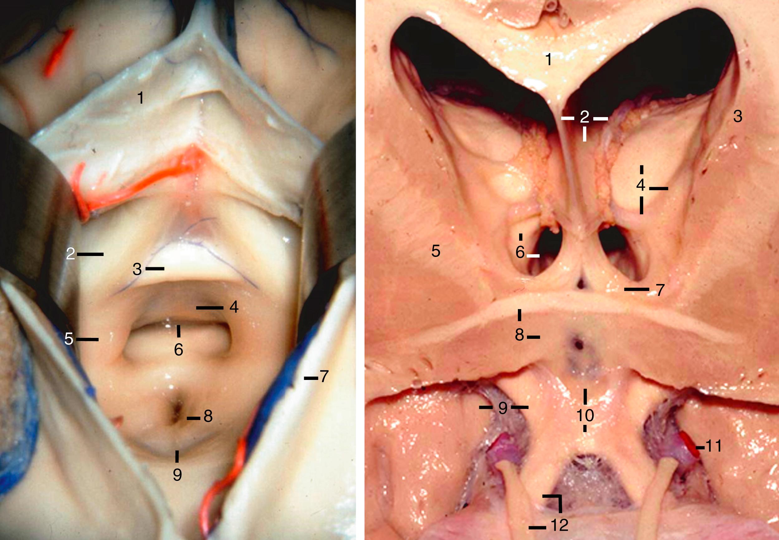 eFigure 2.11, Left, Posterosuperior view of the third ventricle as in interforniceal approach. 1, Column of fornix; 2, column of fornix; 3, anterior commissure; 4, lamina terminalis; 5, hypothalamus; 6, optic recess; 7, body of fornix; 8, infundibular recess; 9, tuber cinereum. Right, Coronal view at the level of lamina terminalis. 1, Corpus callosum; 2, septum pellucidum, body of fornix, and choroid plexus; 3, caudate nucleus; 4, thalamus and thalamostriate vein (empty); 5, internal capsule; 6, foramen of Monro and anterior tubercle of thalamus; 7, column of fornix; 8, anterior commissure and substantia innominata; 9, uncus and optic tract; 10, lamina terminalis and optic chiasm; 11, supraclinoid carotid artery; 12, optic nerve and olfactory tract.