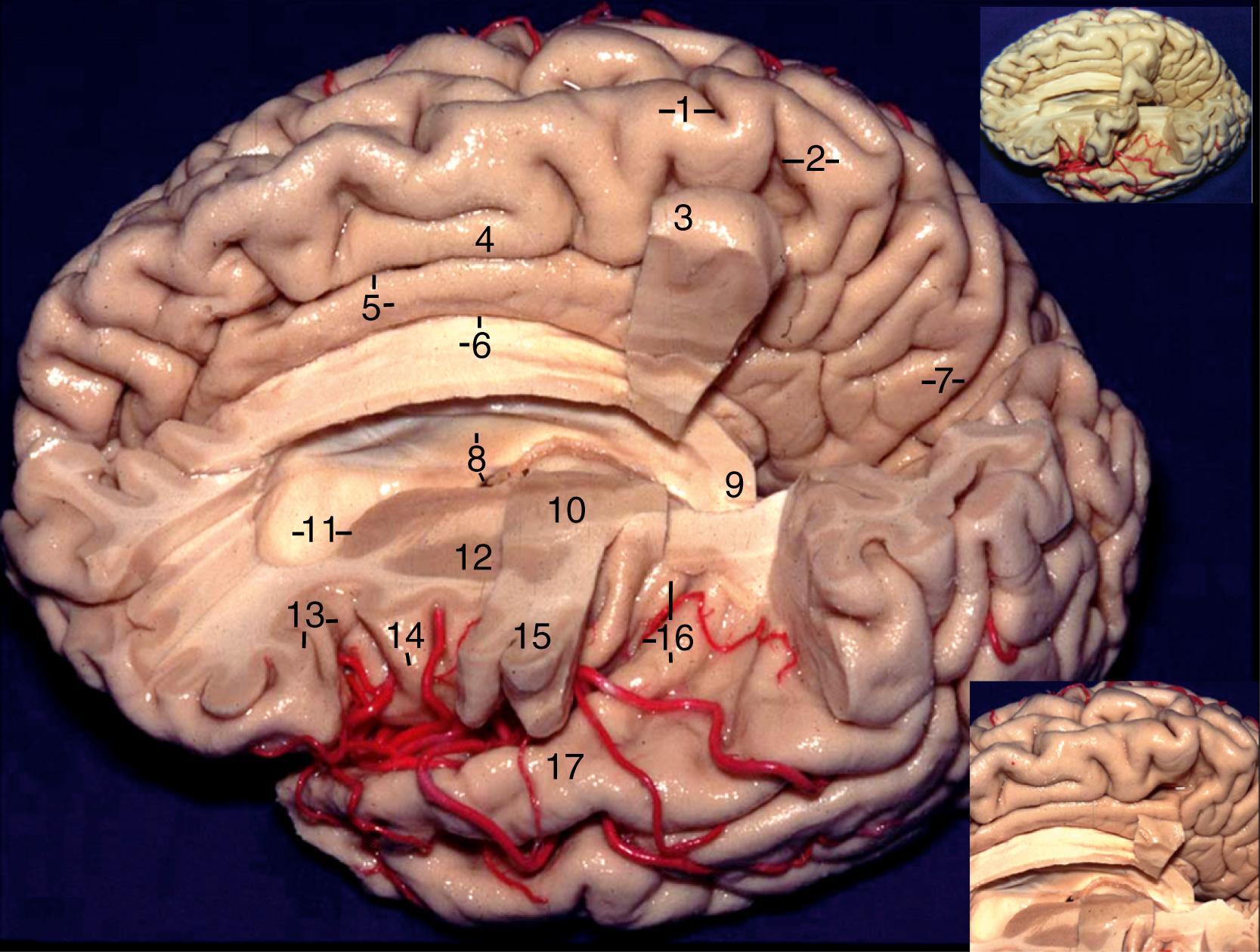 Figure 2.5, Main figure, Superolateral view of the left cerebral hemisphere and the medial surface of the right hemisphere. 1, Precentral gyrus and central sulcus; 2, marginal ramus of cingulate sulcus and postcentral gyrus; 3, precentral gyrus at the midline (it starts above the cingulate sulcus); 4, medial frontal gyrus or superior frontal gyrus; 5, cingulate sulcus and gyrus; 6, corpus callosum and callosal sulcus; 7, precuneus and parieto-occipital sulcus; 8, septum pellucidum and foramen of Monro; 9, splenium of corpus callosum; 10, posterior limb of internal capsule; 11, frontal horn and head of caudate nucleus; 12, lentiform nucleus; 13, pars orbitalis and anterior limiting sulcus of insula; 14, second short gyrus of insula and insular apex; 15, precentral gyrus at the sylvian fissure; 16, long gyrus of insula, inferior limiting sulcus of insula, and Heschl gyrus; 17, superior temporal gyrus. Note that the precentral gyrus at the sylvian fissure is related to the posterior half of the insula. Lower inset shows the location of the precentral gyrus at the midline in relation to marginal ramus of cingulate sulcus and splenium of corpus callosum; upper inset shows the relationship of the precentral gyrus to the rest of the brain.