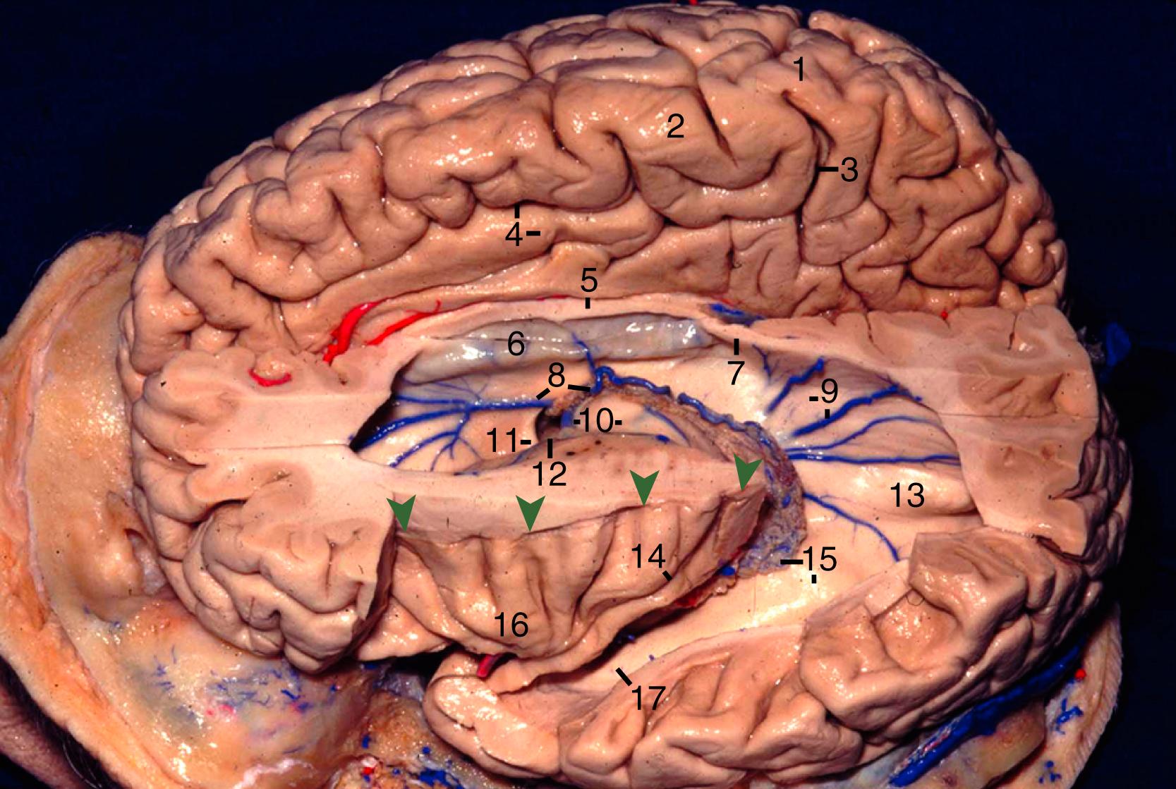 Figure 2.8, Superolateral view of left lateral ventricle. 1, Postcentral gyrus; 2, precentral gyrus; 3, marginal ramus of cingulate sulcus; 4, cingulate gyrus and sulcus; 5, body of corpus callosum; 6, septum pellucidum; 7, splenium of corpus callosum; 8, anterior septal and superior choroidal veins; 9, bulb of callosum and medial atrial vein; 10, thalamostriate vein and thalamus (anterior tubercle); 11, column of fornix; 12, foramen of Monro; 13, calcar avis; 14, central sulcus of insula; 15, choroid plexus and atrium; 16, apex of insula; 17, temporal horn; green arrowheads indicate the superior limiting sulcus of insula.