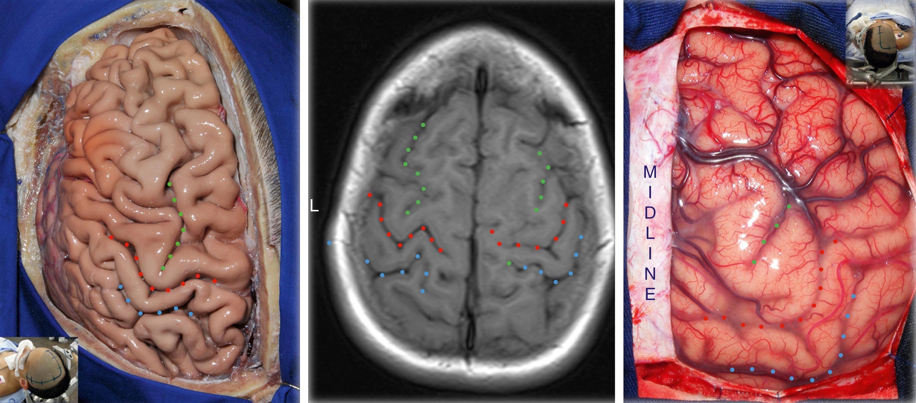 Figure 2.3, Left, Anatomic dissection displaying the left cerebral hemisphere; the green dots show the superior frontal sulcus, red dots show the central sulcus, and blue dots show the postcentral sulcus. The inset displays the approximate position of the head. Center, Axial MR image; the green dots show the superior frontal sulcus, red dots show the central sulcus, and blue dots show the postcentral sulcus. Right, Surgical photograph of the right cerebral hemisphere; the green dots show the superior frontal sulcus, red dots show the central sulcus, and blue dots show the postcentral sulcus. The inset indicates the position of the head.