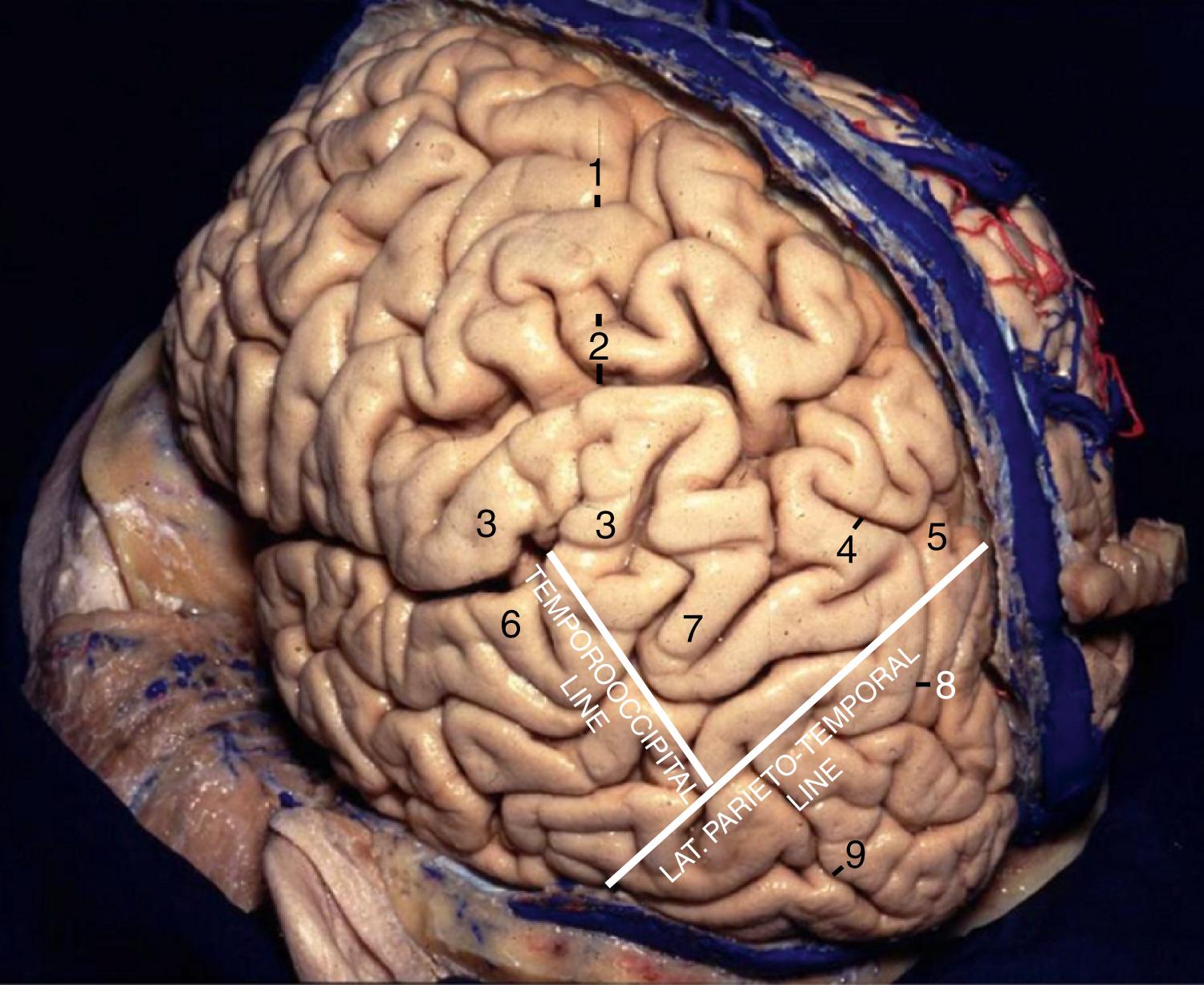 Figure 2.4, Posterolateral view of the left hemisphere. 1, Central sulcus; 2, postcentral gyrus and sulcus; 3, supramarginal gyrus; 4, intraparietal sulcus; 5, superior parietal lobule; 6, superior temporal gyrus; 7, angular gyrus; 8, intraoccipital sulcus (continuation of intraparietal sulcus); 9, lateral occipital sulcus.