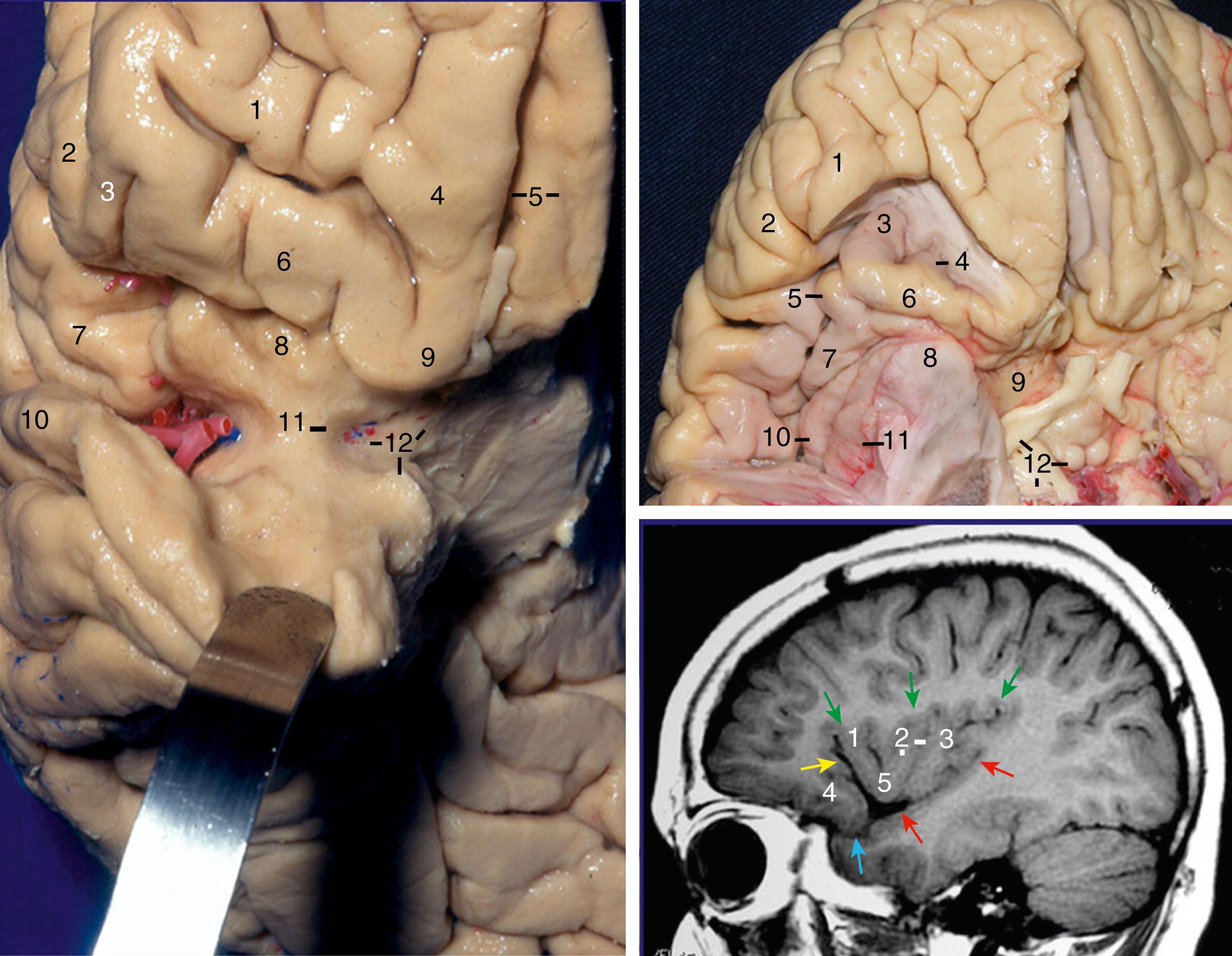 Figure 2.6, Left, Anterobasal view. The planum polare (horizontal portion) has been retracted inferiorly. 1, Anterior orbital gyrus; 2, pars orbitalis; 3, lateral orbital gyrus; 4, medial orbital gyrus; 5, olfactory sulcus and rectus gyrus; 6, posterior orbital gyrus; 7, pars triangularis; 8, anterior surface of insula; 9, posteromedial orbital lobule (junction between the medial and posterior orbital gyri); 10, superior temporal gyrus; 11, limen insulae (between anterior perforated substance [APS] and insular pole); 12, APS and semilunar gyrus (uncus). Upper right, Basal view. The posterior orbital gyrus and posteromedial orbital lobule have been removed to display the anterior surface of insula. 1, Lateral orbital gyrus; 2, pars triangularis; 3, first short gyrus of insula; 4, accessory gyrus of insula; 5, second short gyrus and apex of insula; 6, transverse gyrus of insula; 7, third short gyrus of insula; 8, insular pole; 9, APS; 10 and 11, long gyri of insula; 12, optic tract, mammillary body, and crus cerebri. Note that the short gyri end at the medial edge of insular pole and long gyri end at the lateral edge of insular pole. Lower right, Sagittal MR image. 1, First short gyrus of insula; 2, central sulcus and third short gyrus of insula; 3, long gyrus of insula; 4, posterior orbital gyrus; 5, apex of insula; the green arrows indicate the superior limiting sulcus of insula; the yellow arrow indicates the anterior limiting sulcus of insula (anterior insular compartment of sylvian fissure); the blue arrow indicates the anterior opercular compartment of sylvian fissure; the red arrows indicate the inferior limiting sulcus of insula.