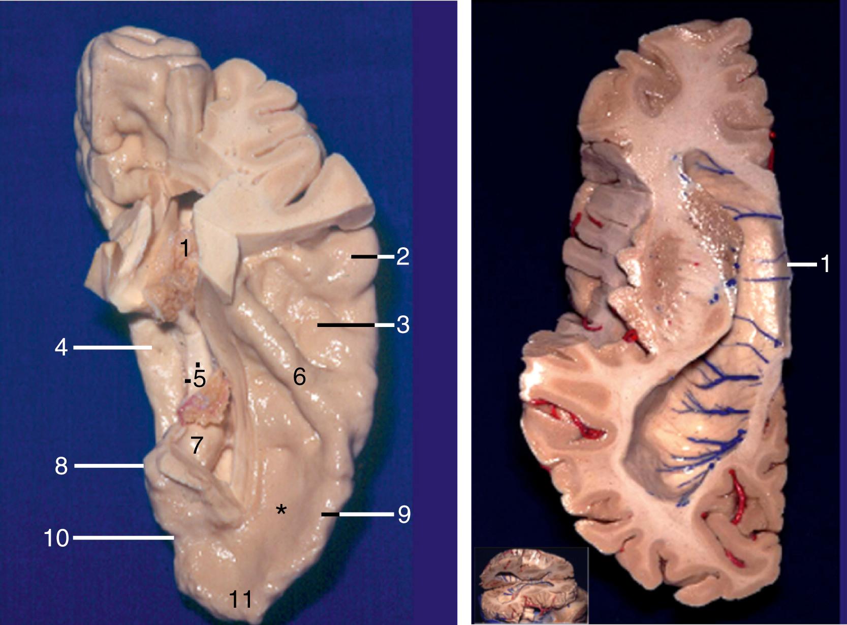 Figure 2.7, Left, Anterosuperior view of the left temporal lobe. 1, Atrium; 2, posterior transverse temporal gyrus; 3, middle transverse temporal gyrus; 4, parahippocampal gyrus; 5, fornix and dentate gyrus; 6, Heschl gyrus; 7, head of hippocampus; 8, uncus apex; 9, vertical portion of planum polare; 10, rhinal incisura; 11, horizontal portion of planum polare; ∗, floor of planum polare. The middle and posterior transverse temporal gyri form the planum temporale. Right, Basal view of roof of lateral ventricle. 1, Septum pellucidum. The veins of the roof of the lateral ventricle drain toward the midline. The inset demonstrates how the cut was made.