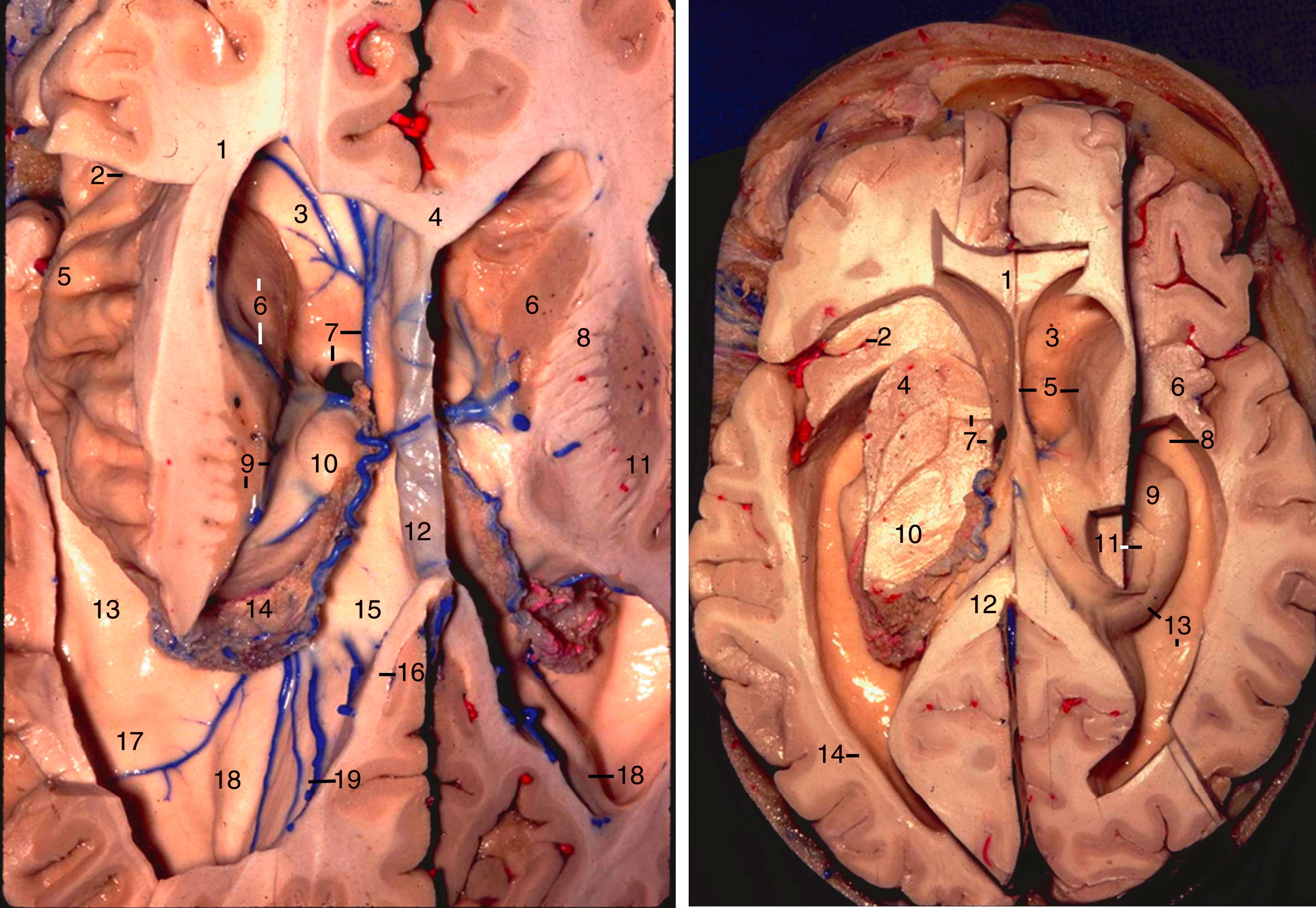 eFigure 2.1, Left, Superior view of the lateral ventricle. 1, Anterior isthmus; 2, anterior limiting sulcus of insula; 3, rostrum of corpus callosum; 4, genu of corpus callosum; 5, apex of insula; 6, head of caudate nucleus and anterior caudate vein; 7, anterior septal vein and column of fornix; 8, anterior limb of internal capsule; 9, body of caudate nucleus and striothalamic sulcus (containing thalamostriate vein); 10, thalamus; 11, lentiform nucleus; 12, septum pellucidum; 13, collateral eminence; 14, choroid plexus of atrium; 15, crus of fornix; 16, forceps major; 17, collateral trigone; 18, calcar avis; 19, bulb of callosum and medial atrial veins. Right, Superior view of the lateral ventricle. 1, Genu of corpus callosum; 2, anterior limiting sulcus of insula; 3, rostrum of corpus callosum; 4, putamen; 5, septum pellucidum and head of caudate nucleus; 6, anterior insula; 7, anterior commissure, column of fornix, and foramen of Monro; 8, uncal recess; 9, head of hippocampus; 10, thalamus; 11, fimbria of fornix; 12, splenium of corpus callosum; 13, tail of hippocampus and collateral trigone; 14, tapetum.