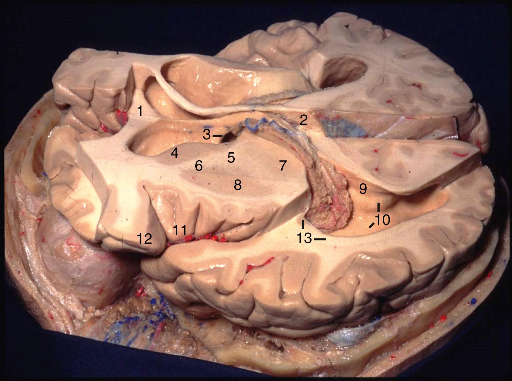 eFigure 2.2, Superolateral view. 1, Genu of corpus callosum; 2, splenium of corpus callosum; 3, foramen of Monro and column of fornix; 4, head of caudate nucleus; 5, genu of internal capsule; 6, anterior limb of internal capsule; 7, thalamus; 8, lentiform nucleus; 9, bulb of callosum; 10, calcar avis and collateral trigone; 11, apex of insula; 12, pars orbitalis; 13, tail of caudate nucleus and tapetum.