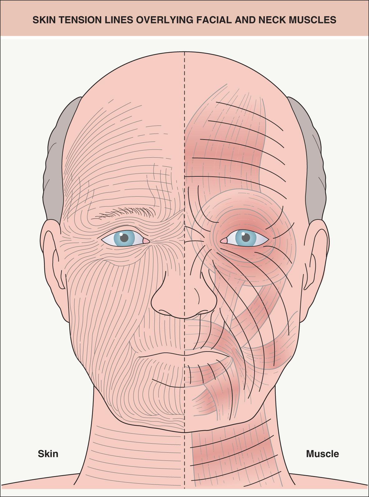 Fig. 142.6, Skin tension lines overlying facial and neck muscles.