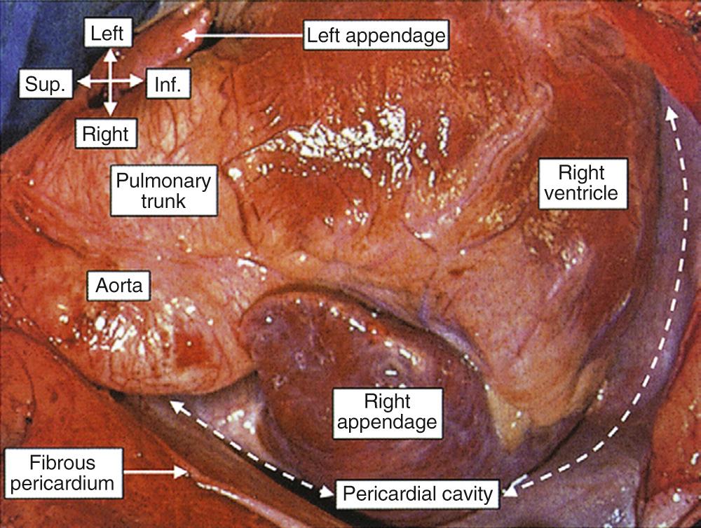 FIGURE 47-1, The heart is shown as seen by the surgeon through a median sternotomy. The pericardial cavity has been opened and is between the fibrous pericardium and the epicardium. The compass shows the orientation. Inf., Inferior; Sup., superior.