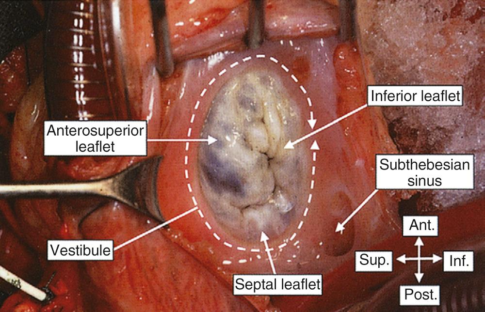 FIGURE 47-11, The right atrium has been opened to show the smooth vestibule of the tricuspid valve. The three leaflets of the valve are positioned septally, anterosuperiorly, and inferiorly. Note the extensive subthebesian sinus, often described as subeustachian when the heart is viewed in attitudinally incorrect fashion. Ant., Anterior, Inf., inferior; Post., posterior; Sup., superior.