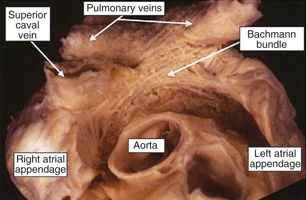 FIGURE 47-12, The heart has been photographed from in front, after the epicardium has been removed from the surface of the anterosuperior interatrial groove. Note the broad sweep of parallel fibers that extend from the crest of the atrial appendage in front of the superior caval vein toward the left atrial appendage. This is Bachmann bundle.