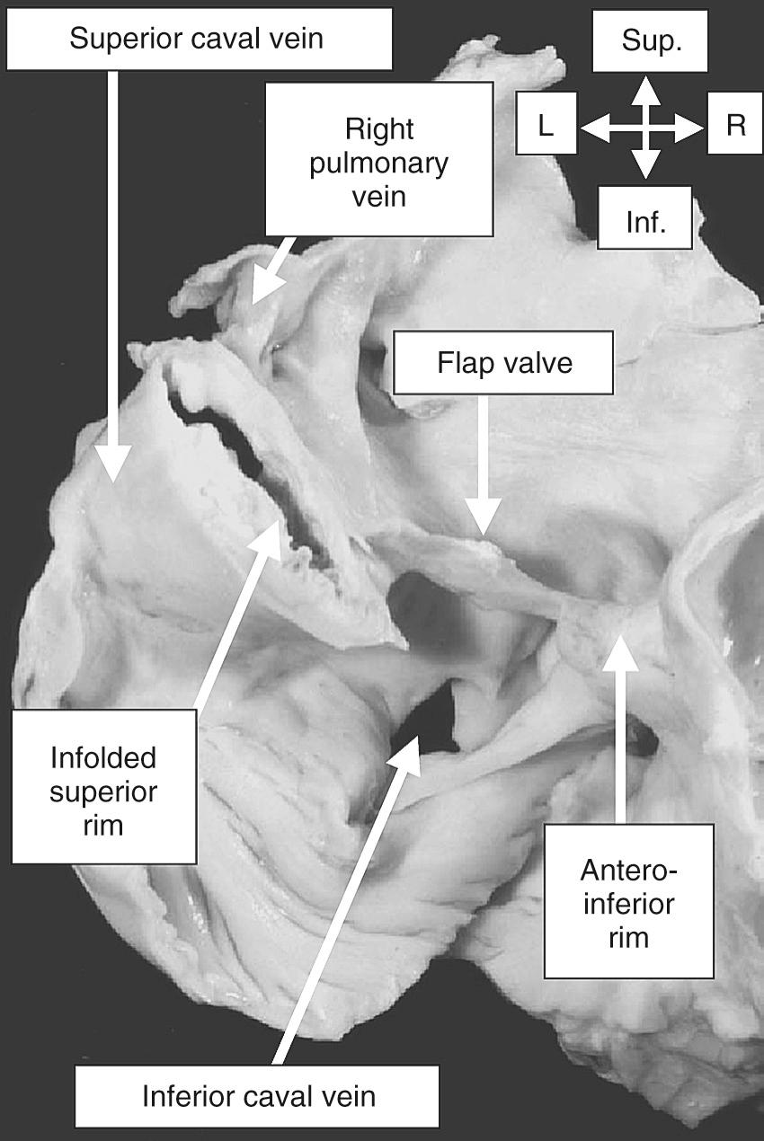 FIGURE 47-13, This heart has been sectioned in four-chamber fashion through the oval fossa. The section shows that the so-called septum secundum is no more than the infolded atrial walls between the tributaries of the systemic venous sinus and the right pulmonary veins. The true septal structures are the floor of the oval fossa (flap valve) and its hinge point from the anteroinferior rim. Inf., Inferior; L, left; R, right; Sup., superior.