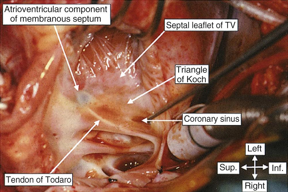 FIGURE 47-14, The right atrium has been opened through a median sternotomy to show the landmarks of the triangle of Koch. In this patient, the continuation of the eustachian valve through the tendon of Todaro is clearly seen, with the tendon inserting into the atrioventricular component of the central fibrous body. Inf., Inferior; Sup., superior; TV, tricuspid valve.