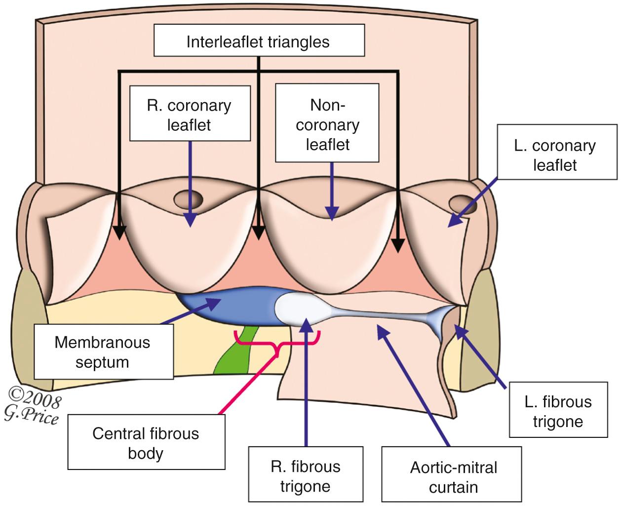 FIGURE 47-15, The left ventricular aspect of the aortic root, illustrating the various components of the fibrous skeleton. The area of fibrous continuity between the leaflets of the aortic and mitral valves is thickened at both ends to form the so-called fibrous trigones. As can be seen, the right trigone is then continuous with the membranous septum, with these structures forming the central fibrous body. Note that the membranous septum itself continues upward to the sinotubular junction as one of the fibrous interleaflet triangles of the aortic root. Note also the location of the left bundle branch (see Fig. 47-26 ). L, Left; R, right.