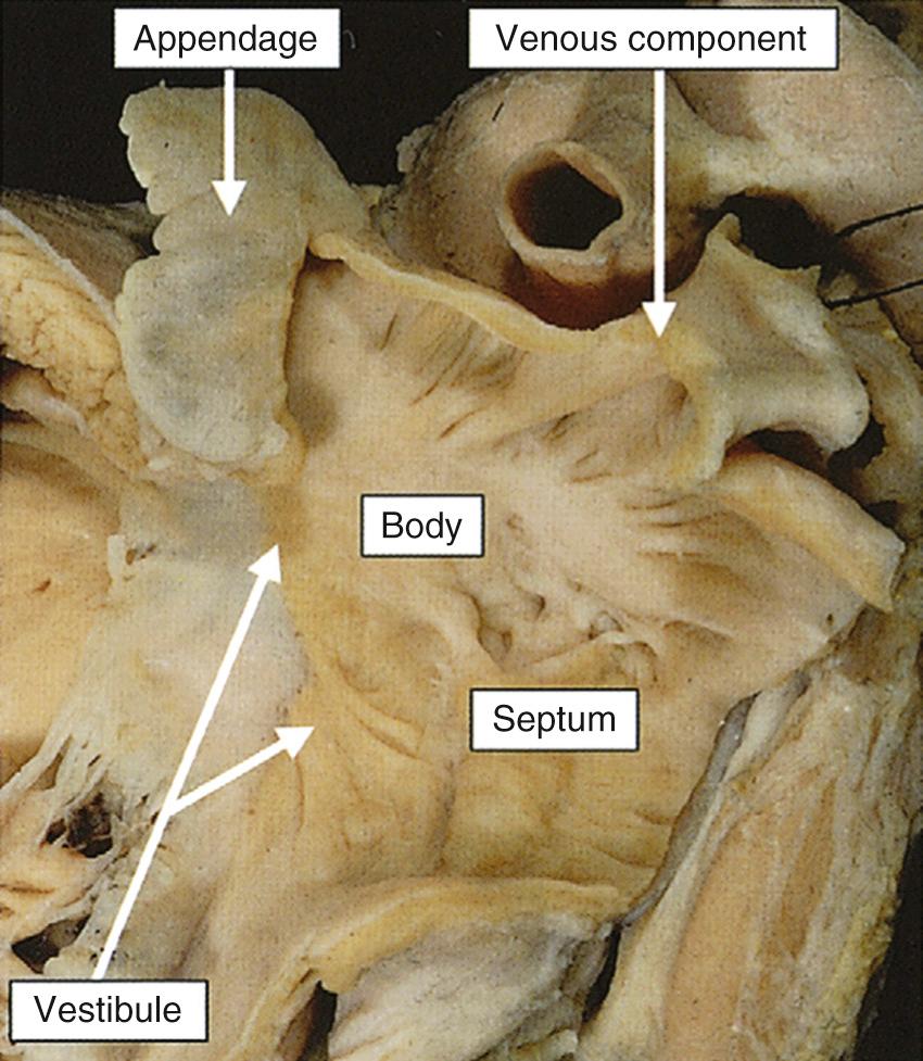 FIGURE 47-16, The morphologically left atrium is photographed from its left side to show the component parts. Note the extensive body, which also receives the septal aspect of the chamber.