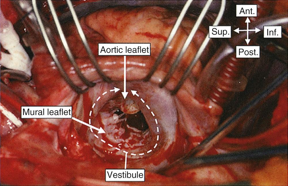 FIGURE 47-17, The left atrium is photographed in the operating room through an incision made in the dome. Note the vestibule of the mitral valve, which has aortic and mural leaflets. Ant., Anterior; Inf., inferior; Post., posterior; Sup., superior.