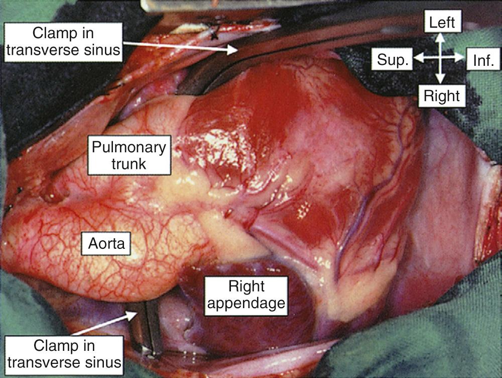 FIGURE 47-2, With the pericardium opened in the operating room, the surgical clamp has been passed through the transverse sinus of the pericardium, which is between the back of the arterial trunks and the front of the atrial chambers. Inf., Inferior; Sup., superior.