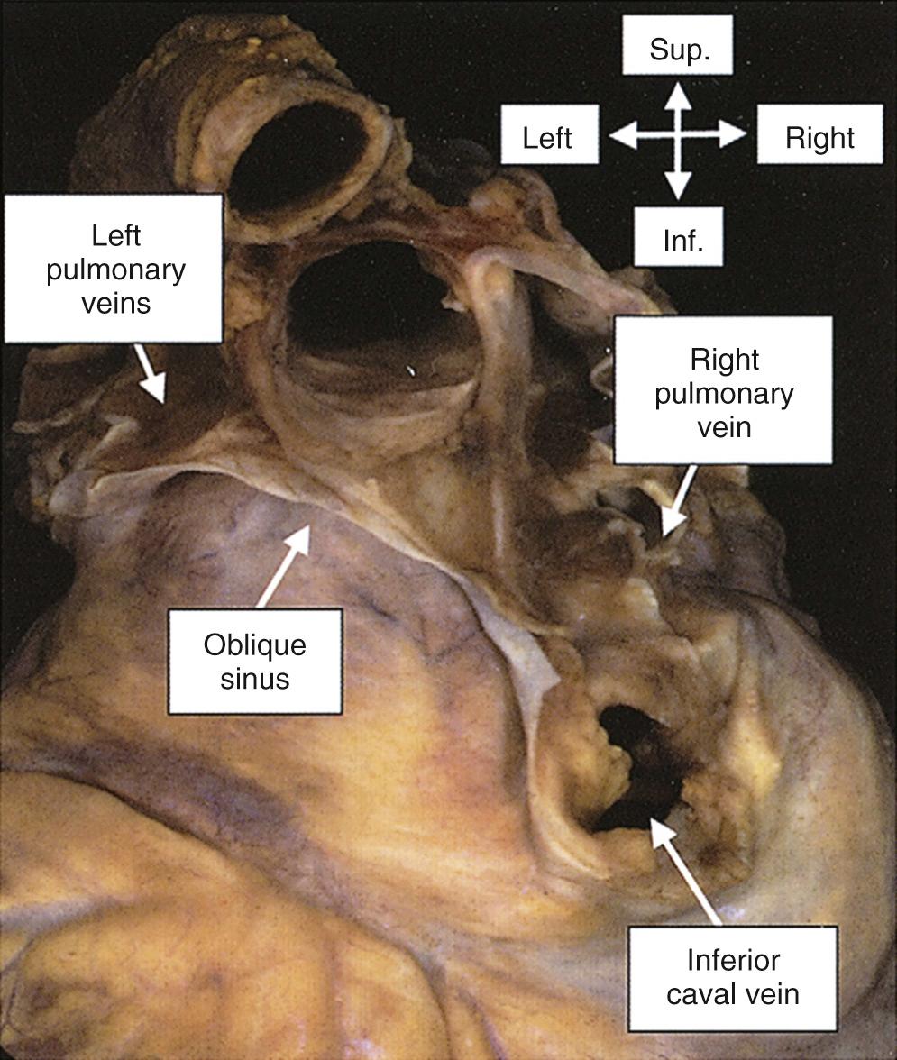 FIGURE 47-3, This anatomic specimen has been removed from the body and is viewed from behind, with the apex pointing downward. The oblique sinus of the pericardium is seen between the pericardial reflections around the pulmonary veins and the inferior caval vein. Inf., Inferior; Sup., superior.