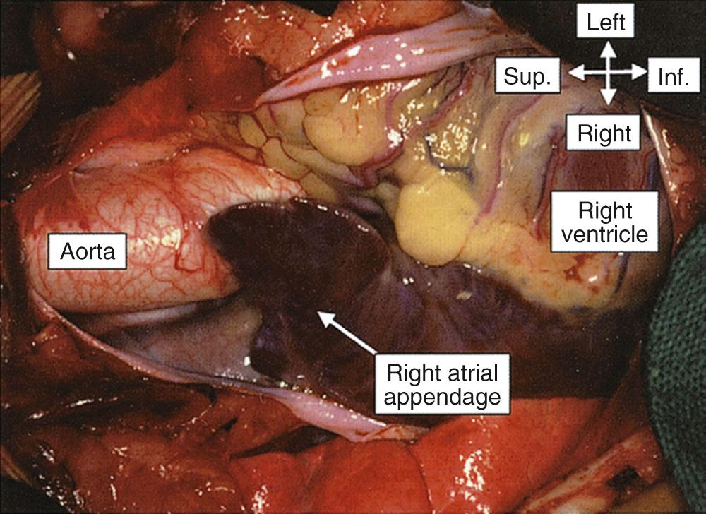 FIGURE 47-4, This picture of the heart, as seen in the operating room through a median sternotomy, shows the typical triangular appearance of the morphologically right atrial appendage. Inf., Inferior; Sup., superior.