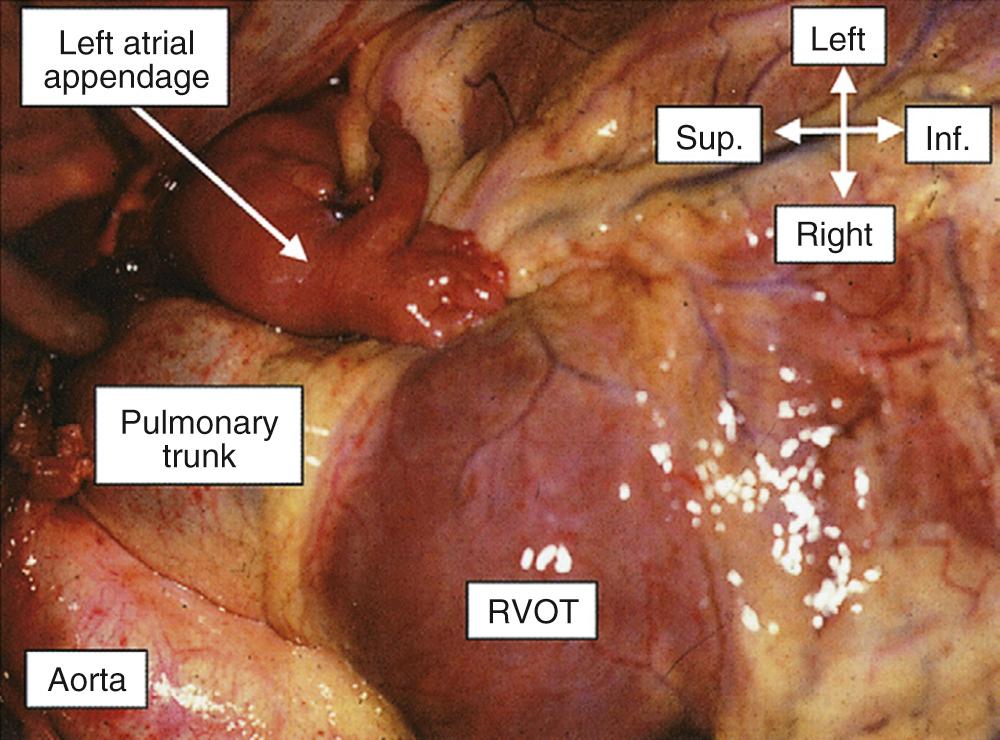 FIGURE 47-5, With the pericardium opened through a median sternotomy, the heart is rotated slightly to show the typical tubular configuration of the morphologically left atrial appendage. Inf., Inferior; RVOT, right ventricular outflow tract; Sup., superior.