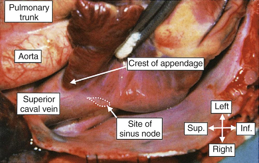 FIGURE 47-8, In this picture, taken in the operating room, the surgeon has reflected the atrial appendage to show the location of the terminal groove and the crest of the appendage. Note the site of the sinus node (dotted lines) . Inf., Inferior; Sup., superior.