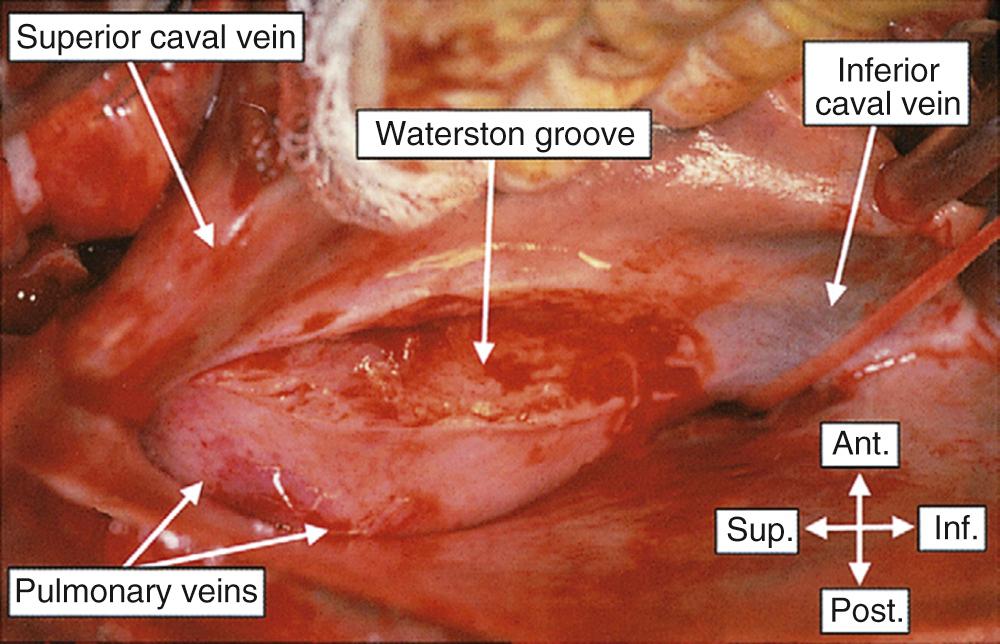 FIGURE 47-9, In this view through a median sternotomy, the surgeon has incised through the epicardium covering Waterston groove, showing the base of the deep fold between the systemic venous tributaries and the right pulmonary veins. Ant., Anterior, Inf., inferior; Post., posterior; Sup., superior.