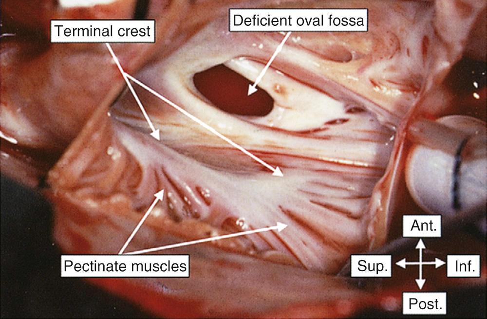 FIGURE 47-10, Opening the right atrial appendage in this patient with a defect in the oval fossa reveals the markedly different configuration of the endocardial surfaces of the pectinate appendage as opposed to the smooth-walled systemic venous sinus. The pectinate muscles originate from the terminal crest, marked externally by the terminal groove (see Fig. 47-7 ). Ant., Anterior, Inf., inferior; Post., posterior; Sup., superior.