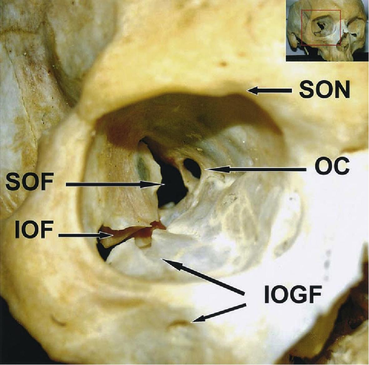 Fig. 4.2, Right orbital cavity: optic canal ( OC ), superior orbital fissure ( SOF ), inferior orbital fissure ( IOF ), infraorbital groove and foramen ( IOGF ), and supra orbital notch ( SON ).