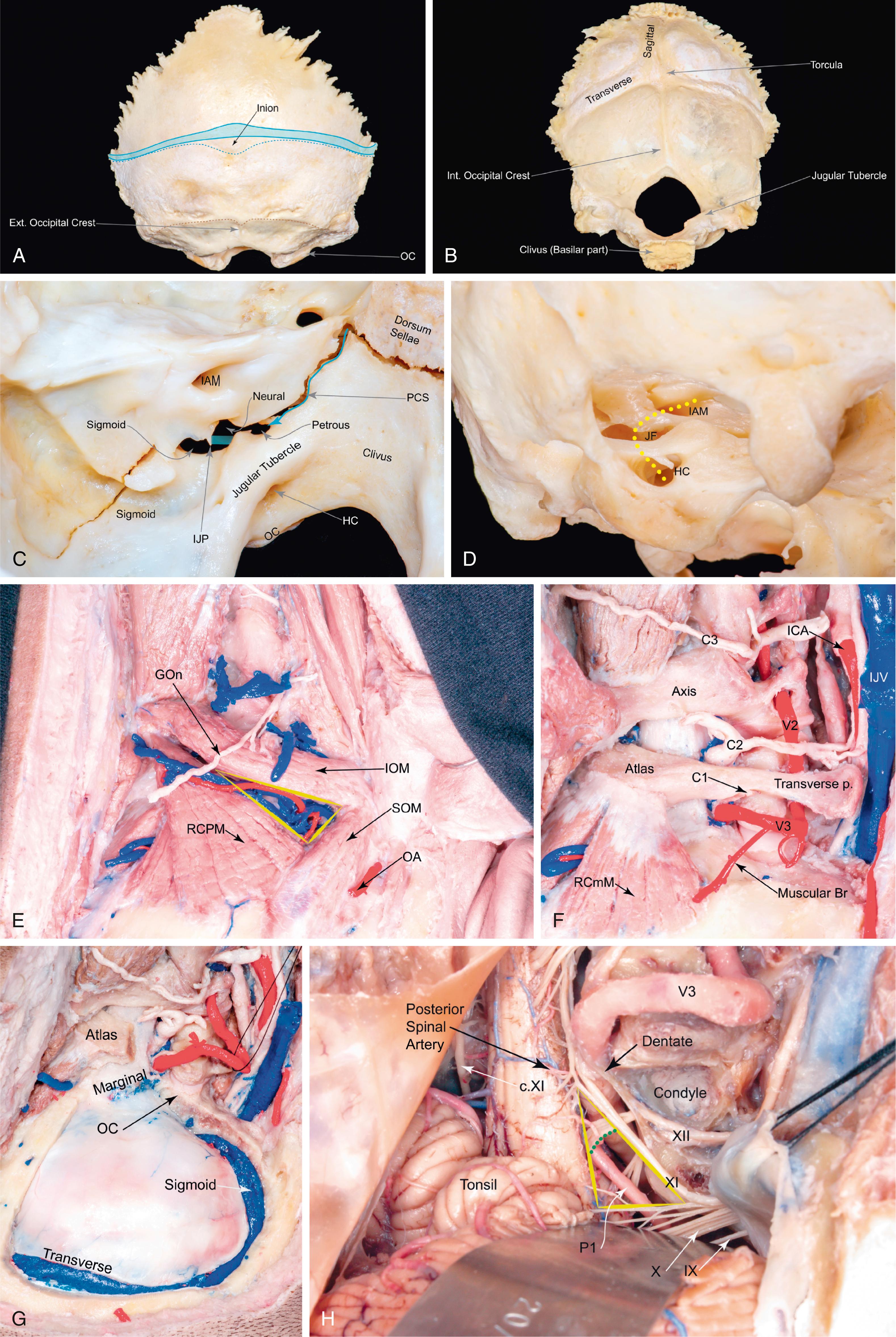 Figure 3.1, Bone anatomy and surgical landmarks relevant to the far lateral approach.