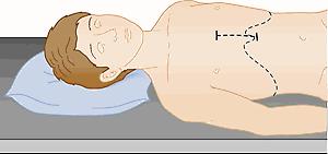 FIGURE 108-1, A partial or limited sternotomy incision.