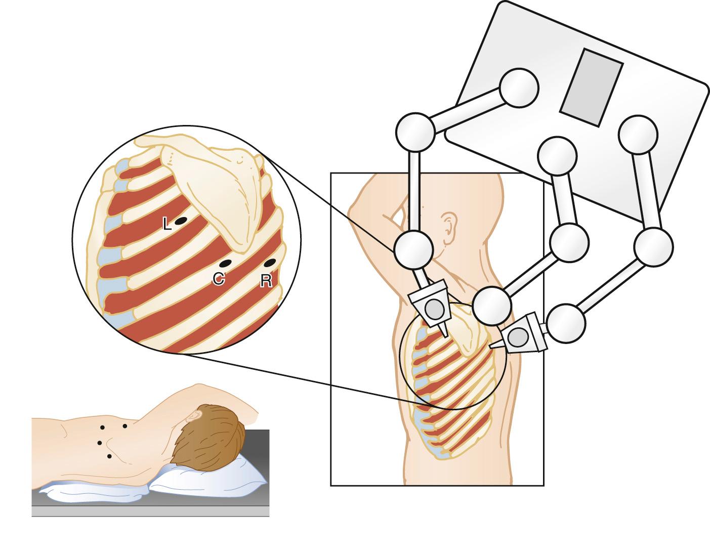 FIGURE 108-4, Port position for robot-assisted thoracoscopic division of vascular ring. The scope and camera are introduced through the central port (C), and instruments are introduced through the other two ports for the robot's left arm (L) and right arm (R).