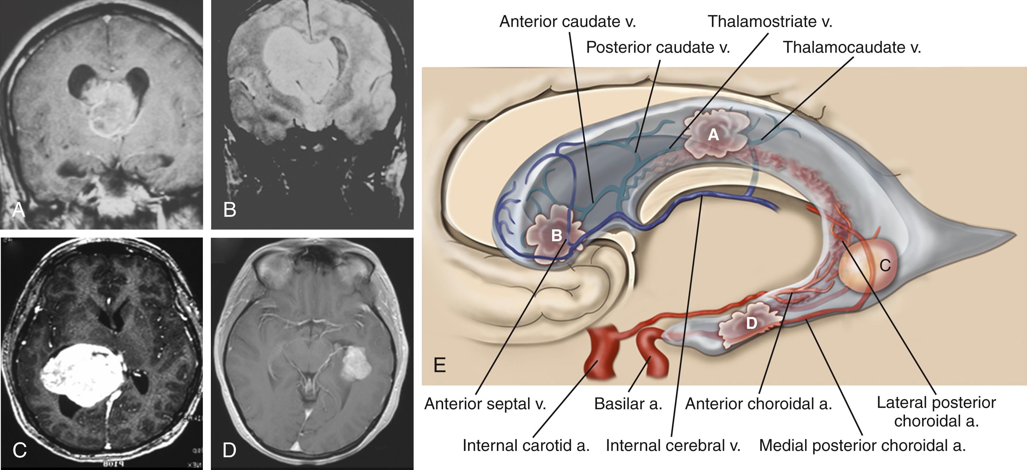 FIGURE 19.1, Enhancedd magnetic resonance imaging of lateral ventricle tumors in common locations, with preferred surgical routes as denoted. (A) Body, anterior transcallosal. (B) Body and frontal horn, combined anterior transcallosal and anterior transsulcal. (C) Atrium, posterior transsulcal/superior parietal lobule. (D) Temporal horn, inferior temporal. (E) Schematic representation highlighting common tumor locations(A, body; B, frontal horn; C, atrium; D, temporal horn) and relevant vascular anatomy of the lateral ventricle.