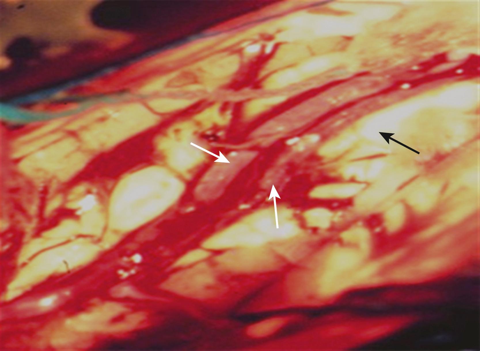 FIGURE 19.2, Intraoperative view of the pericallosal arteries (white arrows) over a distended corpus callosum (black arrow) .