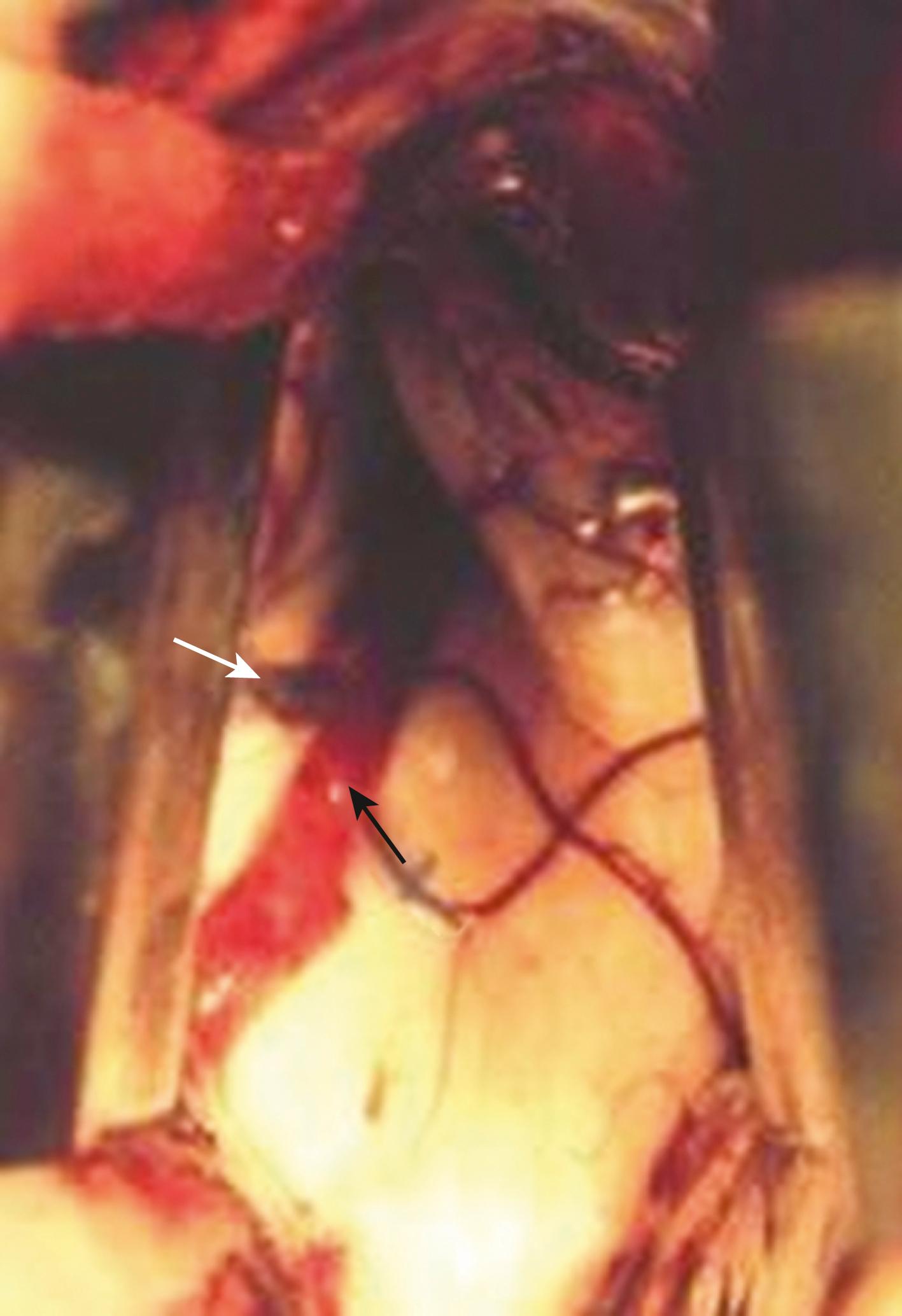 FIGURE 19.3, Intraoperative view of the left lateral ventricle showing the choroid plexus (black arrow) , thalamostriate vein (white arrow) , and septum pellucidum.