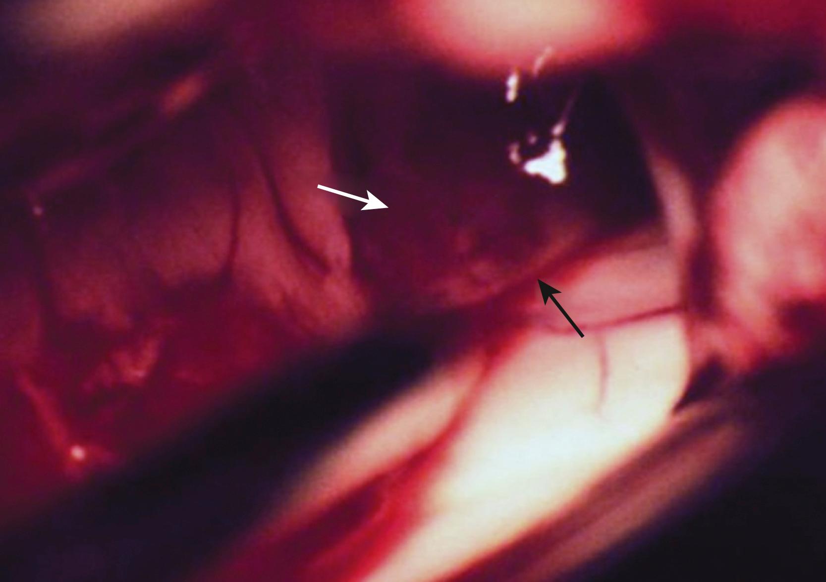 FIGURE 19.4, Intraoperative view of an intraventricular tumor (white arrow) and its interface (black arrow) with the ependymal surface.