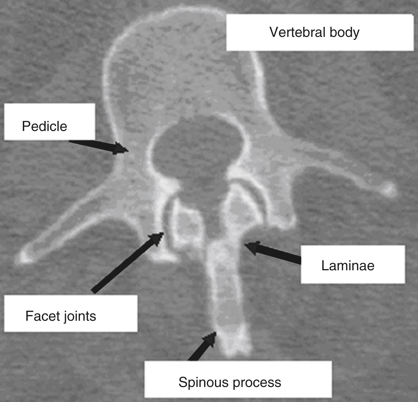 Fig. 167.1, Axial computed tomography image of the L2 vertebral body identifying the dorsal elements.