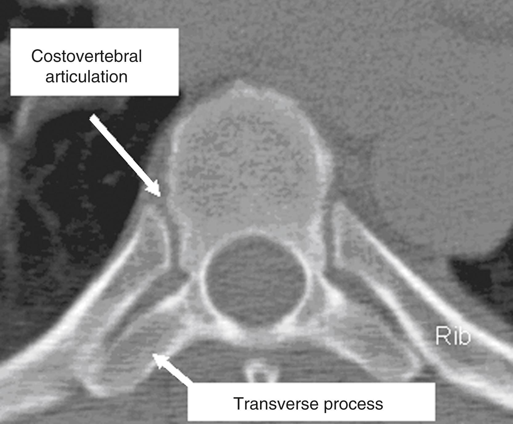 Fig. 167.2, Axial computed tomography image of the T6 vertebral body identifying the relationship between the vertebral body and the rib head’s articulations.