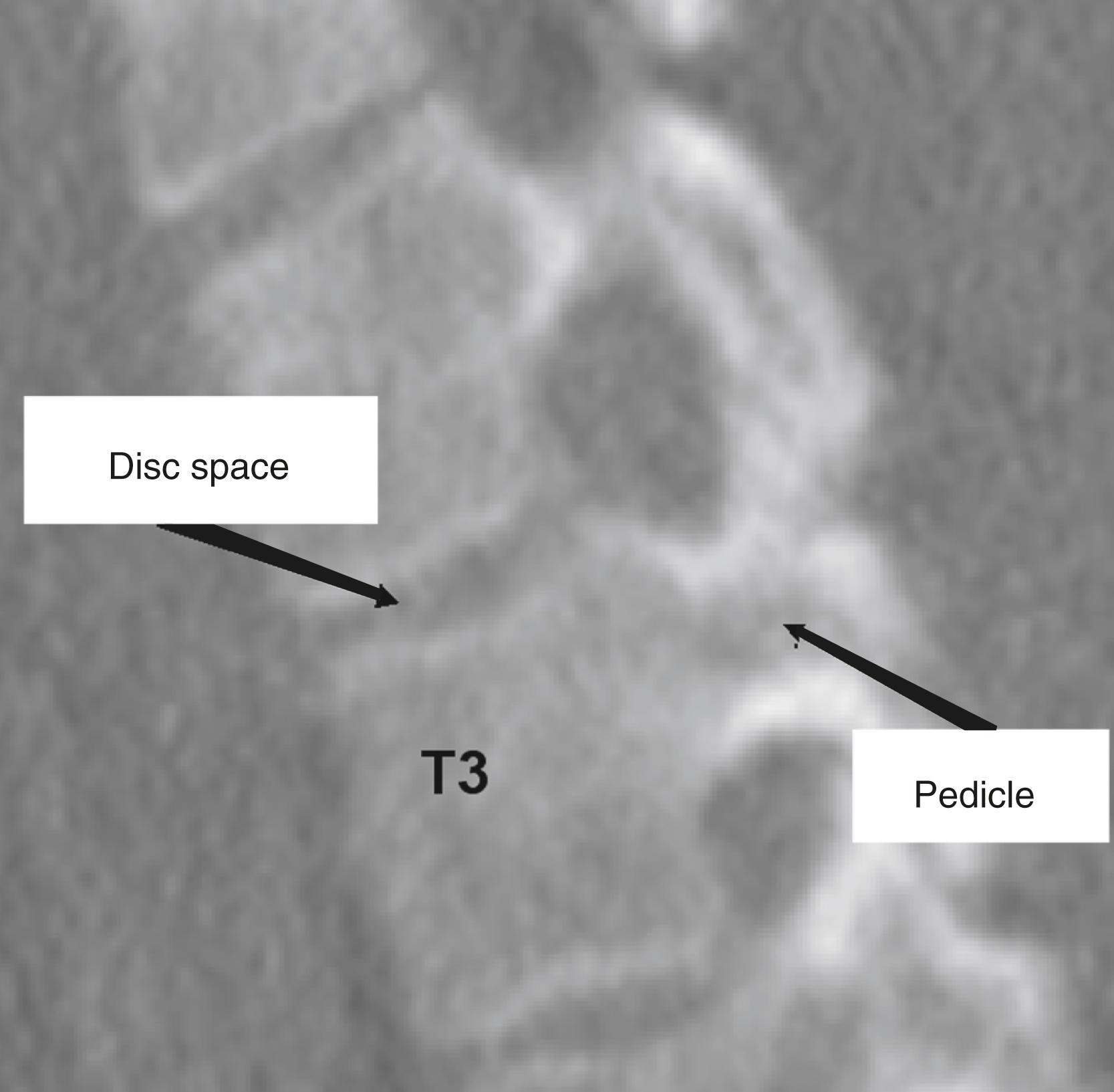 Fig. 167.3, Sagittal computed tomography reformatted image of the T2 and T3 vertebral bodies illustrating the relationship of the pedicle to the intervertebral disc space in the thoracic spine.