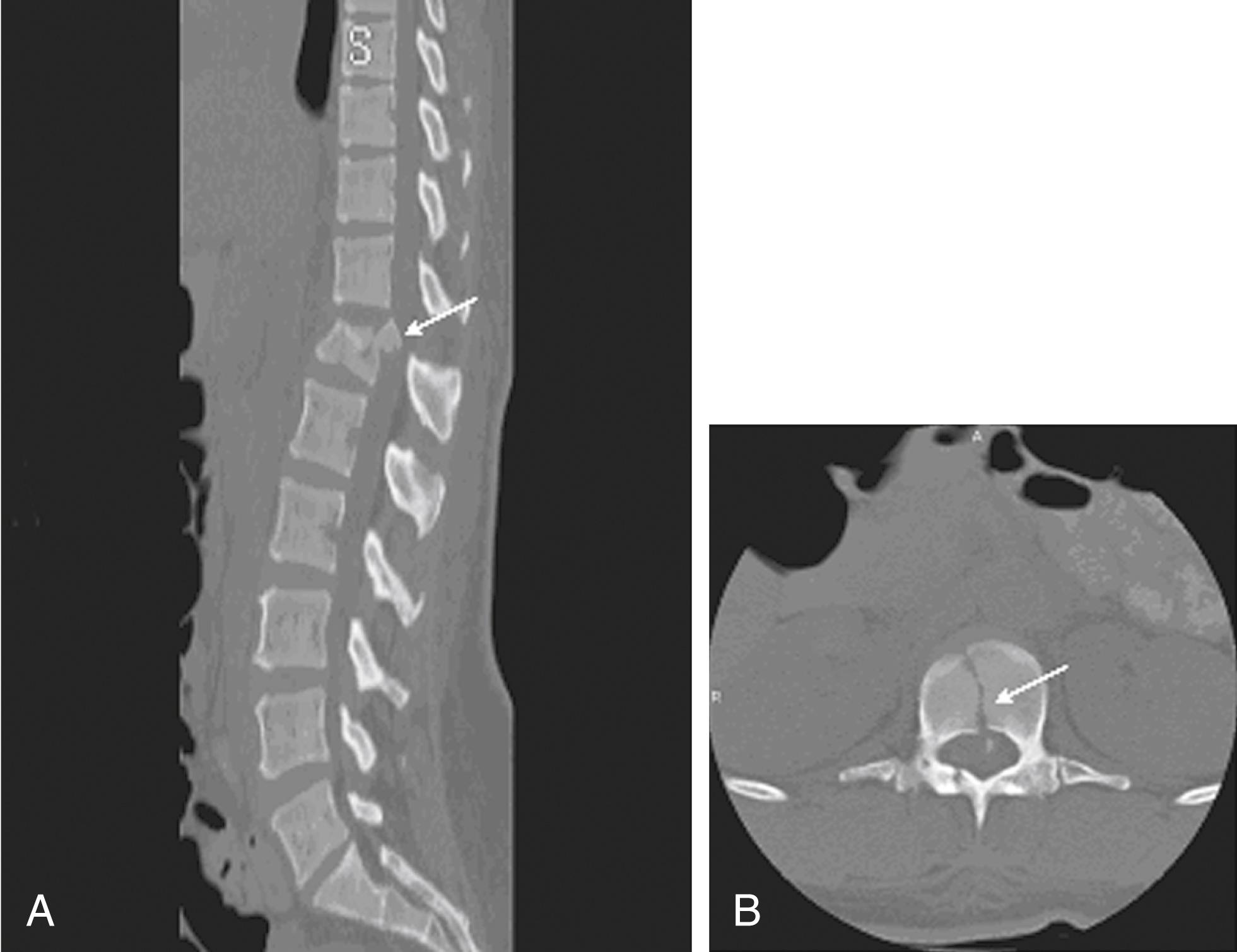 Fig. 167.4, T12 burst fracture sustained after a motor vehicle accident. Note the high definition of the posterior displaced fragment ( A, arrow ), along with the vertebral body sagittal fracture ( B, arrow ) and the associated laminae fractures.