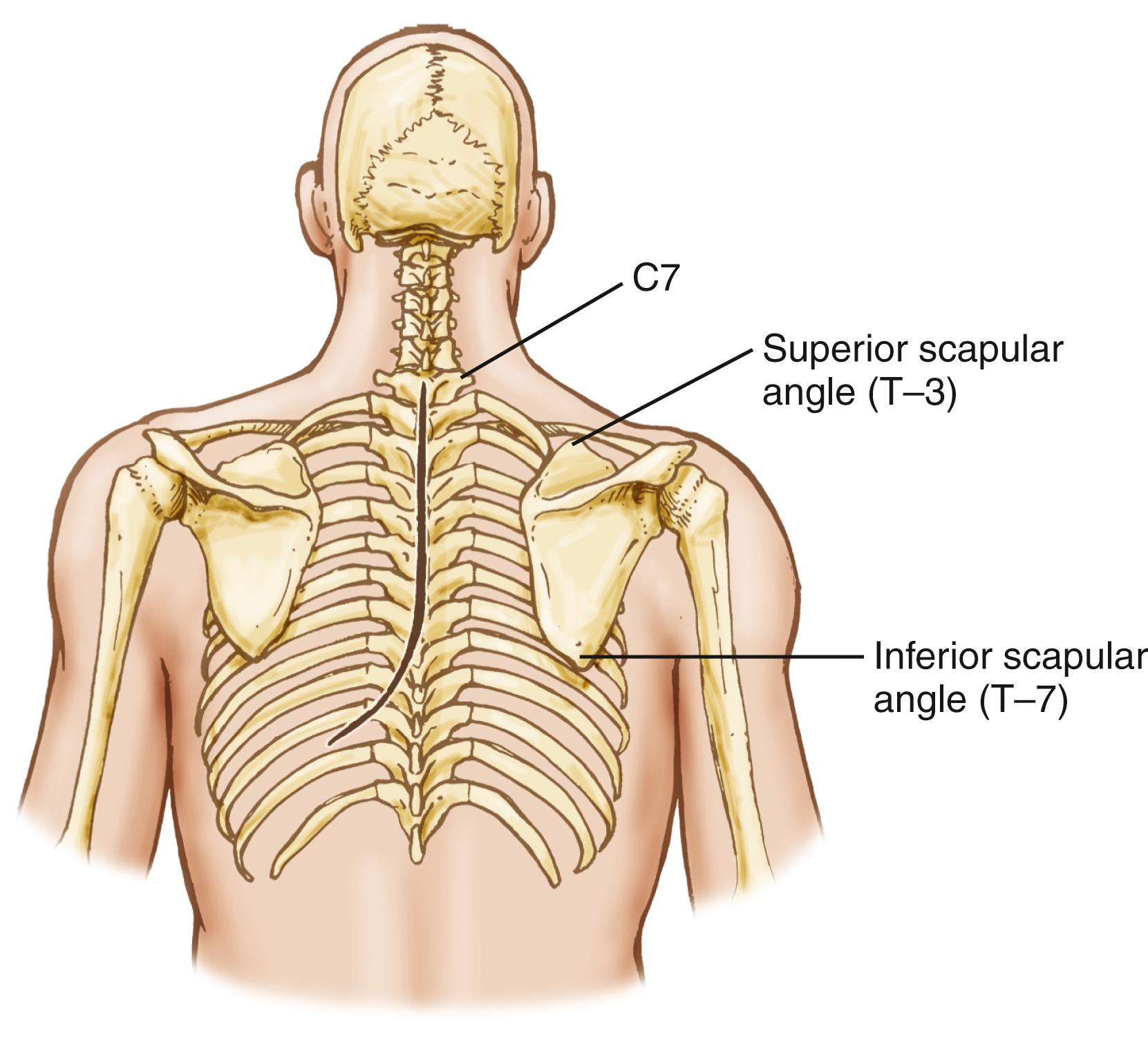 FIGURE 178.1, Relationship of the scapula to the incision, as well as the surgical approach to the cervicothoracic junction, via the lateral parascapular extrapleural approach.