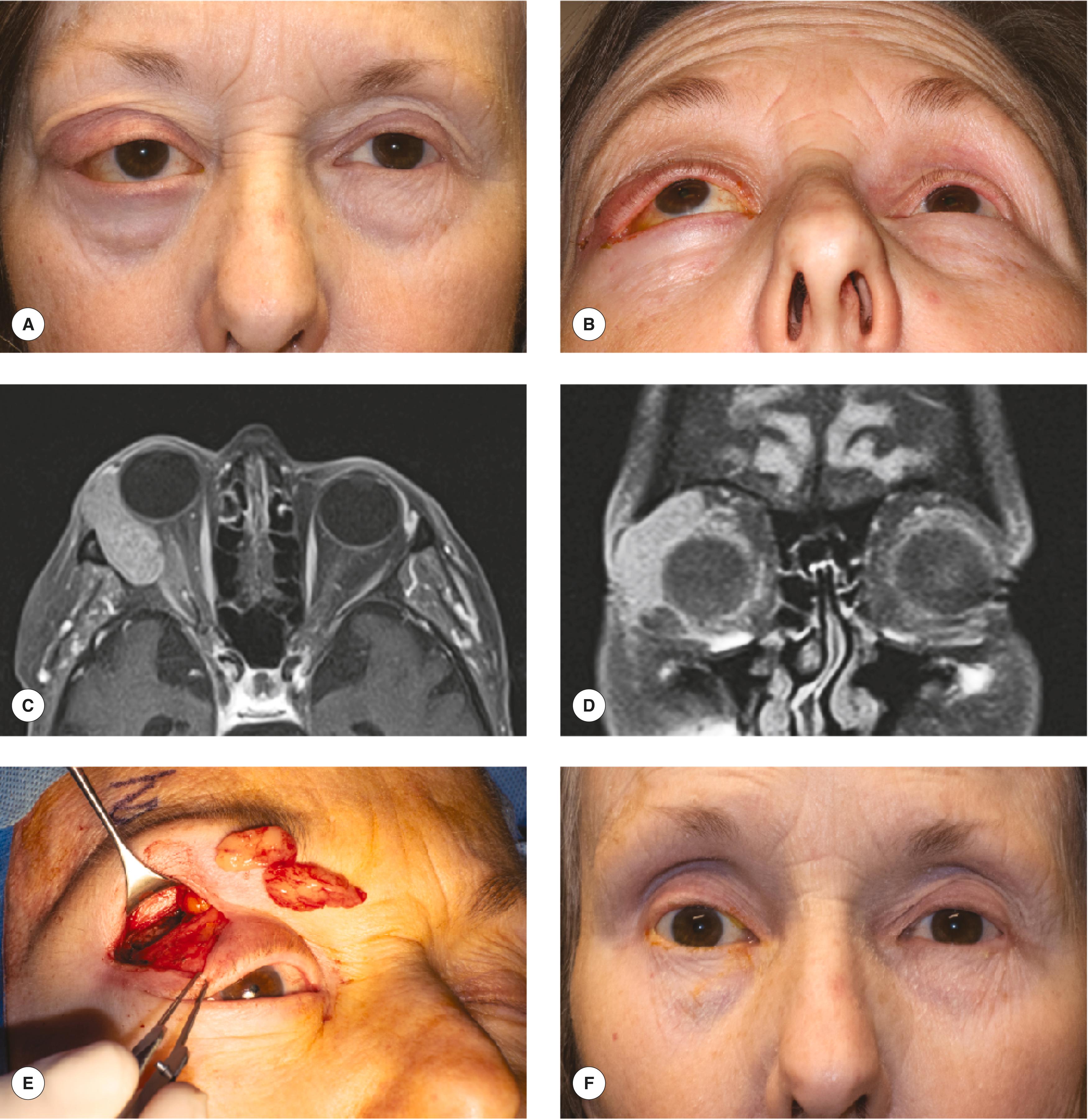 Figure 15.1, Incisional biopsy of presumed lymphoid tumor through a small anterior orbitotomy. ( A, B ) Proptosis present for a few weeks, progressing. No pain. ( C, D ) Enlarged lacrimal gland molding the shape of the globe, presumed to be a lymphoid tumor. ( E ) Incisional biopsy is necessary to confirm the diagnosis. This can be accomplished through a small transcutaneous anterior orbital biopsy. Portions of the tumor are removed to confirm the diagnosis. A malt lymphoma was diagnosed. ( F ) Following radiation treatments, the mass has shrunken and the patient has a sunken sulcus.